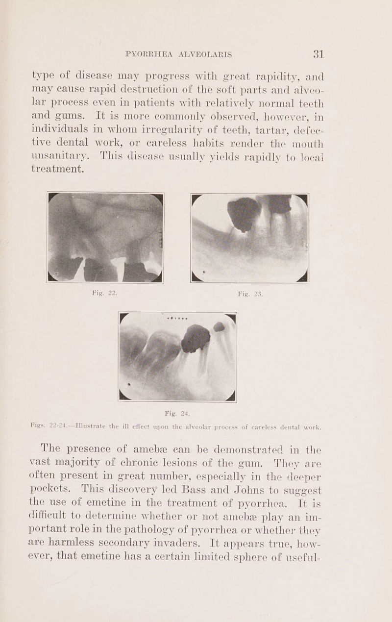 type of disease may progress with great rapidity, and may cause rapid destruction of the soft parts and alveo- lar process even in patients with relatively normal teeth and gums. It is more commonly observed, however, in individuals in whom irregularity of teeth, tartar, defec- tive dental work, or careless habits render the mouth unsanitary. This disease usually yields rapidly to loeai treatment. Migar22: Hie, 23: V Peres N Fig. 24. Figs. 22-24.—Tllustrate the ill effect upon the alveolar process of careless dental work. The presence of amebe can be demonstrated in the vast majority of chronic lesions of the gum. They are often present in great number, especially in the deeper pockets. This discovery led Bass and Johns to suggest the use of emetine in the treatment of pyorrhea. It is difficult to determine whether or not amebe play an im- portant role in the pathology of pyorrhea or whether they are harmless secondary invaders. It appears true, how- ever, that emetine has a certain limited sphere of useful-