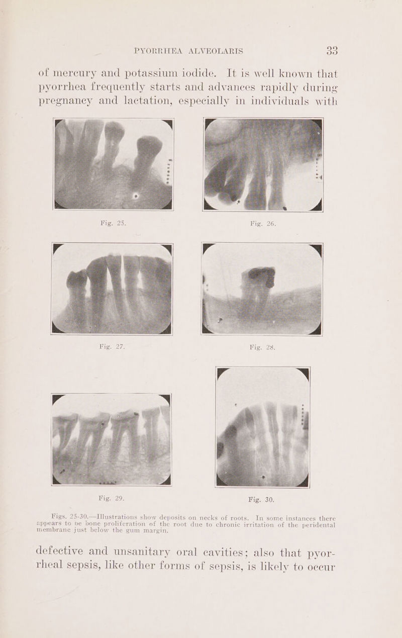 of mereury and potassium iodide. It is well known that pyorrhea frequently starts and advances rapidly during pregnancy and lactation, especially in individuals with Bige2 3: Bigs 26; Life, Da. Fig. 28. Fig. 29. Bigs 30s Figs. 25-30.—TIllustrations show deposits on necks of roots. In some instances there appears to be bone proliteration of the root due to chronic irritation of the peridental membrane just below the gum margin. defective and unsanitary oral cavities; also that pyor- rheal sepsis, like other forms of sepsis, is likely to occur