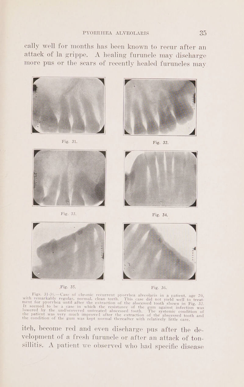 eally well for months has been known to recur after an attack of la grippe. A healing furuncle may discharge more pus or the sears of recently healed furuncles may Pier ois Figs 32: Fig. 34. ign 35. Fig, 36, Figs. 31-36.—Case of chronic recurrent pyorrhea alveolaris in a patient, age 70, with remarkably regular, normal, clean teeth. This case did not yield well to treat- ment for pyorrhea until after the extraction of the abscessed tooth shown in Big.» 32. It seemed to be a case in which the resistance of the gum against infection was lowered by the undiscovered untreated abscessed tooth. The systemic condition of the patient was very much improved after the extraction of the abscessed tooth and the condition of the gum was kept normal thereafter with relatively little care. itch, become red and even discharge pus after the de- velopment of a fresh furuncle or after an attack of ton- sillitis. A patient we observed who had specifie disease