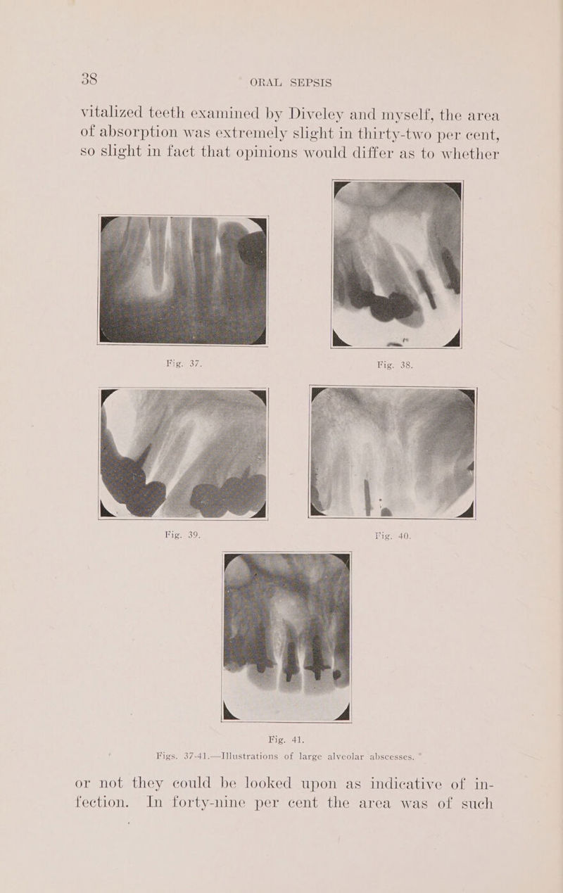 vitalized teeth examined by Diveley and myself, the area of absorption was extremely slight in thirty-two per cent, so slight in fact that opinions would differ as to whether gioameoee Fig. 38. Fig. 39. Fig. 40. Figs. 37-41.—Illustrations of large alveolar abscesses. * or not they could be looked upon as indicative of in- fection. In forty-nine per cent the area was of such