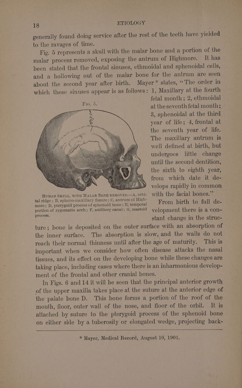 generally found doing service after the rest of the teeth have yielded to the ravages of time. | Fig. 5 represents a skull with the malar bone and a portion of the malar process removed, exposing the antrum of Highmore. It has been stated that the frontal sinuses, ethmoidal and sphenoidal cells, and a hollowing out of the malar bone for the antrum are seen about the second year after birth. Mayer * states, ‘‘ The order in which these sinuses appear is as follows: 1, Maxillary at the fourth fetal month; 2, ethmoidal at the seventh fetal month; 8, sphenoidal at the third year of life; 4, frontal at the seventh year of life. The maxillary antrum is well defined at birth, but undergoes little change until the second dentition, the sixth to eighth year, from which date it de- velops rapidly in common HUMAN SKULL, WITH MALAR BONE REMOVED.—A, orbi- with the facial bones.”’ tal ridge ; B, spheno-maxillary fissure ; C, antrum of High- 3 more; D, pterygoid process of sphenoid bone; E, temporal From bir th to full de- portion of zygomatic arch; F, auditory canal; G, mastoid velopment there is a con- Benin stant change in the struc- ture; bone is deposited on the outer surface with an absorption of the inner surface. The absorption is slow, and the walls do not reach their normal thinness until after the age of maturity. This is important when we consider how often disease attacks the nasal tissues, and its effect on the developing bone while these changes are taking place, including cases where there is an inharmonious develop- ment of the frontal and other cranial bones. In Figs. 6 and 14 it will be seen that the principal anterior growth of the upper maxilla takes place at the suture at the anterior edge of the palate bone D. This bone forms a portion of the roof of the mouth, floor, outer wall of the nose, and floor of the orbit. It is attached by suture to the pterygoid process of the sphenoid bone on either side by a tuberosity or elongated wedge, projecting back- * Mayer, Medical Record, August 10, 1901.