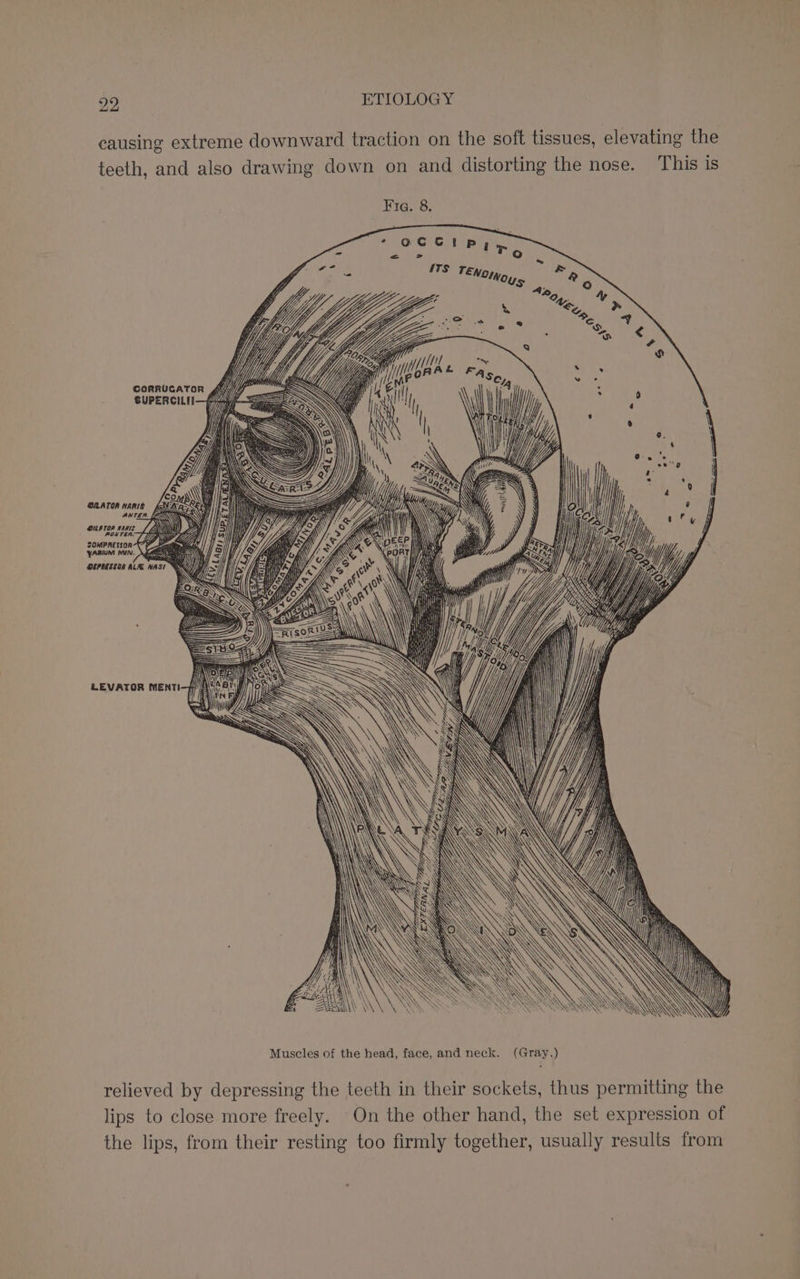 causing extreme downward traction on the soft tissues, elevating the teeth, and also drawing down on and distorting the nose. This is Fie. 8. = % Te TS TENoW¢ &amp; @ Ce) An Je Sin »y Pe 2 / ‘ =. s ? corrucatorn Af SUPERCILII—fu GILATOR NARIS OU ATOR HARIS POSTEA. SOMPRESSOR yARium mun. OEPRESECA ALAE WA ww 1 7AN\ I f j yy % Se , d, Vy | | 5 \\ EN Upto |\\\\\ HINO RNR ANGRIS\SS SSSA _0waAnl LEVATOR MENT A y|9 SSS \S : healt N 4 = SSS ‘ 2, Vii ertdiinte, Dap WAAG LM te, Rig Muscles of the head, face, and neck. (Gray.) relieved by depressing the teeth in their sockets, thus permitting the lips to close more freely. On the other hand, the set expression of the lips, from their resting too firmly together, usually results from