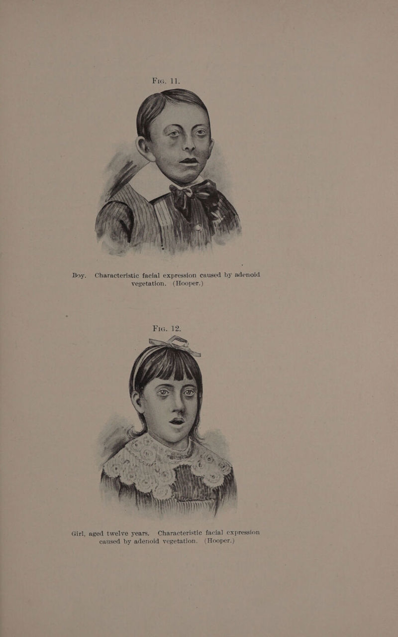 . Boy. Characteristic facial expression caused by adenoid vegetation. (Hooper.) Fig. 12. Girl, aged twelve years. Characteristic facial expression caused by adenoid vegetation. (Hooper.)