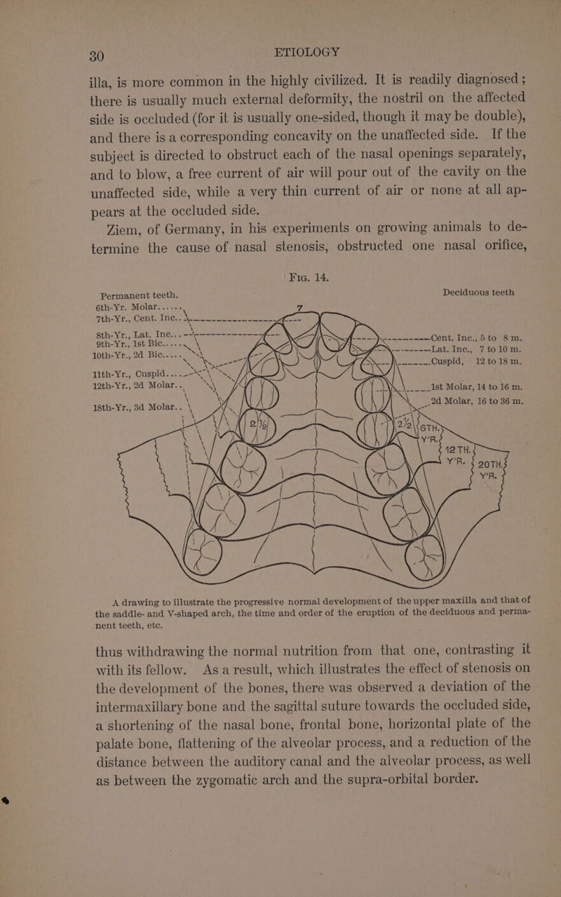 ila, is more common in the highly civilized. It is readily diagnosed ; there is usually much external deformity, the nostril on the affected side is occluded (for it is usually one-sided, though it may be double), and there is a corresponding concavity on the unaffected side. If the subject is directed to obstruct each of the nasal openings separately, and to blow, a free current of air will pour out of the cavity on the unaffected side, while a very thin current of air or none at all ap- pears at the occluded side. Ziem, of Germany, in his experiments on growing animals to de- termine the cause of nasal stenosis, obstructed one nasal orifice, Fig. 14. Permanent teeth. Deciduous teeth 6th-Yr. Molar...... 7 eh Wit Grete Thos) Nee ee ee ae : \ 8th-Yr., Lat. Ine... ac —--------- . 9th-Yr., ist Bic..... mec 10thaYry, 20) Bier. ni Sx lith-Yr., Cuspid....--&lt;Y oS 12th-Yr., 2d Molar. “4 \ \ 18th-Yr., 3d Molar.. \ A drawing to illustrate the progressive normal development of the upper maxilla and that of the saddle- and V-shaped arch, the time and order of the eruption of the deciduous and perma- nent teeth, etc. thus withdrawing the normal nutrition from that one, contrasting it with its fellow. Asa result, which illustrates the effect of stenosis on the development of the bones, there was observed a deviation of the intermaxillary bone and the sagittal suture towards the occluded side, a shortening of the nasal bone, frontal bone, horizontal plate of the palate bone, flattening of the alveolar process, and a reduction of the distance between the auditory canal and the alveolar process, as well as between the zygomatic arch and the supra-orbital border.