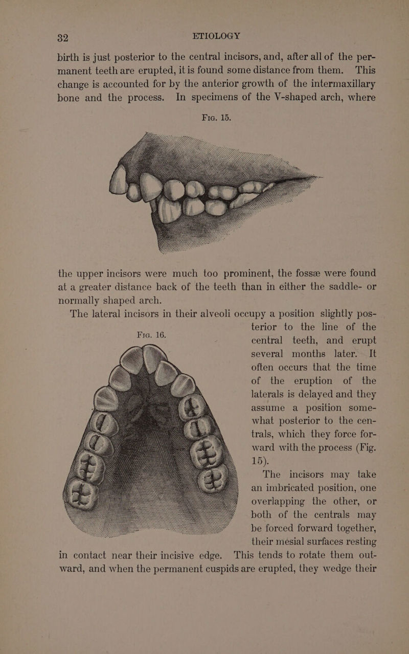 birth is just posterior to the central incisors, and, after all of the per- manent teeth are erupted, itis found some distance from them. This change is accounted for by the anterior growth of the intermaxillary bone and the process. In specimens of the V-shaped arch, where the upper incisors were much too prominent, the fossz were found at a greater distance back of the teeth than in either the saddle- or normally shaped arch. The lateral incisors in their alveoli occupy a position slightly pos- terior to the line of the central teeth, and erupt several months later. It often occurs that the time of the eruption of the laterals is delayed and they assume a position some- what posterior to the cen- trals, which they force for- ward with the process (Fig. 15). The incisors may take an imbricated position, one overlapping the other, or both of the centrals may be forced forward together, their mesial surfaces resting in contact near their incisive edge. This tends to rotate them out- ward, and when the permanent cuspids are erupted, they wedge their