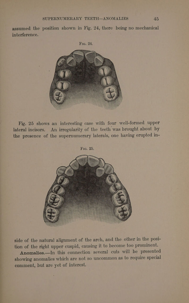 assumed the position shown in Fig. 24, there being no mechanical interference. Fig. 25 shows an interesting case with four well-formed upper lateral incisors. An irregularity of the teeth was brought about by the presence of the supernumerary laterals, one having erupted in- Fig. 25. side of the natural alignment of the arch, and the other in the posi- tion of the right upper cuspid, causing it to become too prominent. Anomalies.—In this connection several cuts will be presented showing anomalies which are not so uncommon as to require special comment, but are yet of interest.