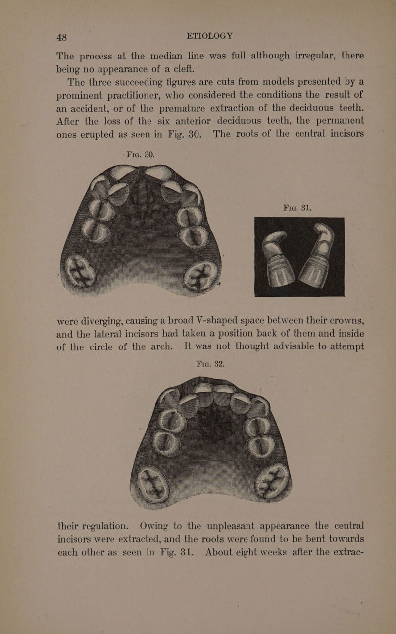 The process at the median line was full although irregular, there being no appearance of a cleft. The three succeeding figures are cuts from models presented by a prominent practitioner, who considered the conditions the result of an accident, or of the premature extraction of the deciduous teeth. After the loss of the six anterior deciduous teeth, the permanent ones erupted as seen in Fig. 30. The roots of the central incisors were diverging, causing a broad V-shaped space between their crowns, and the lateral incisors had taken a position back of them and inside of the circle of the arch. It was not thought advisable to attempt Fie. 32. their regulation. Owing to the unpleasant appearance the central incisors were extracted, and the roots were found to be bent towards each other as seen in Fig. 31. About eight weeks after the extrac-