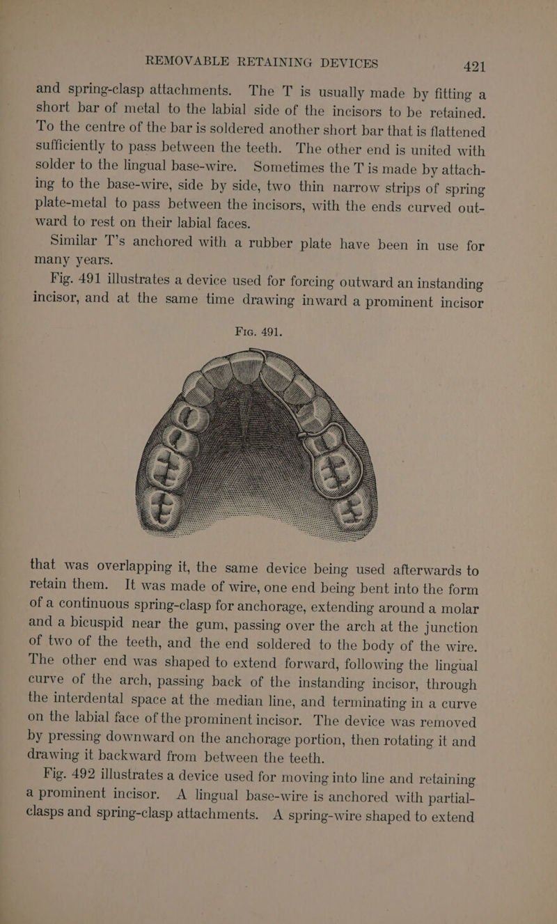 and spring-clasp attachments. The T is usually made by fitting a short bar of metal to the labial side of the incisors to be retained, To the centre of the bar is soldered another short bar that is flattened sufficiently to pass between the teeth. The other end is united with solder to the lingual base-wire. Sometimes the T is made by attach- ing to the base-wire, side by side, two thin narrow strips of spring plate-metal to pass between the incisors, with the ends curved out- ward to rest on their labial faces. Similar T’s anchored with a rubber plate have been in use for many years. Fig. 491 illustrates a device used for forcing outward an instanding incisor, and at the same time drawing inward a prominent incisor that was overlapping it, the same device being used afterwards to retain them. It was made of wire, one end being bent into the form of a continuous spring-clasp for anchorage, extending around a molar and a bicuspid near the gum, passing over the arch at the junction of two of the teeth, and the end soldered to the body of the wire. The other end was shaped to extend forward, following the lingual curve of the arch, passing back of the instanding incisor, through the interdental space at the median line, and terminating in a curve on the labial face of the prominent incisor. The device was removed by pressing downward on the anchorage portion, then rotating it and drawing it backward from between the teeth. Fig. 492 illustrates a device used for moving into line and retaining a prominent incisor. A lingual base-wire is anchored with partial- clasps and spring-clasp attachments. A spring-wire shaped to extend