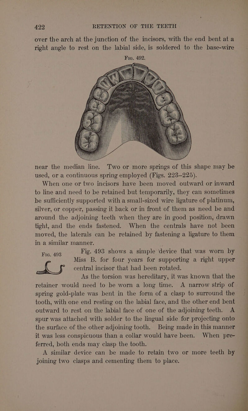 near the median line. Two or more springs of this shape may be used, or a continuous spring employed (Figs. 223-225). When one or two incisors have been moved outward or inward to line and need to be retained but temporarily, they can sometimes be sufficiently supported with a small-sized wire ligature of platinum, silver, or copper, passing it back or in front of them as need be and around the adjoining teeth when they are in good position, drawn tight, and the ends fastened. When the centrals have not been moved, the laterals can be retained by fastening a ligature to them in a similar manner. Fig. 493 Fig. 493 shows a simple device that was worn by Miss B. for four years for supporting a right upper f f central incisor that had been rotated. As the torsion was hereditary, it was known that the retainer would need to be worn a long time. A narrow strip of spring gold-plate was bent in the form of a clasp to surround the tooth, with one end resting on the labial face, and the other end bent outward to rest on the labial face of one of the adjoining teeth. A spur was attached with solder to the lingual side for projecting onto the surface of the other adjoining tooth. Being made in this manner it was less conspicuous than a collar would have been. When pre- ferred, both ends may clasp the tooth. A similar device can be made to retain two or more teeth by joining two clasps and cementing them to place.