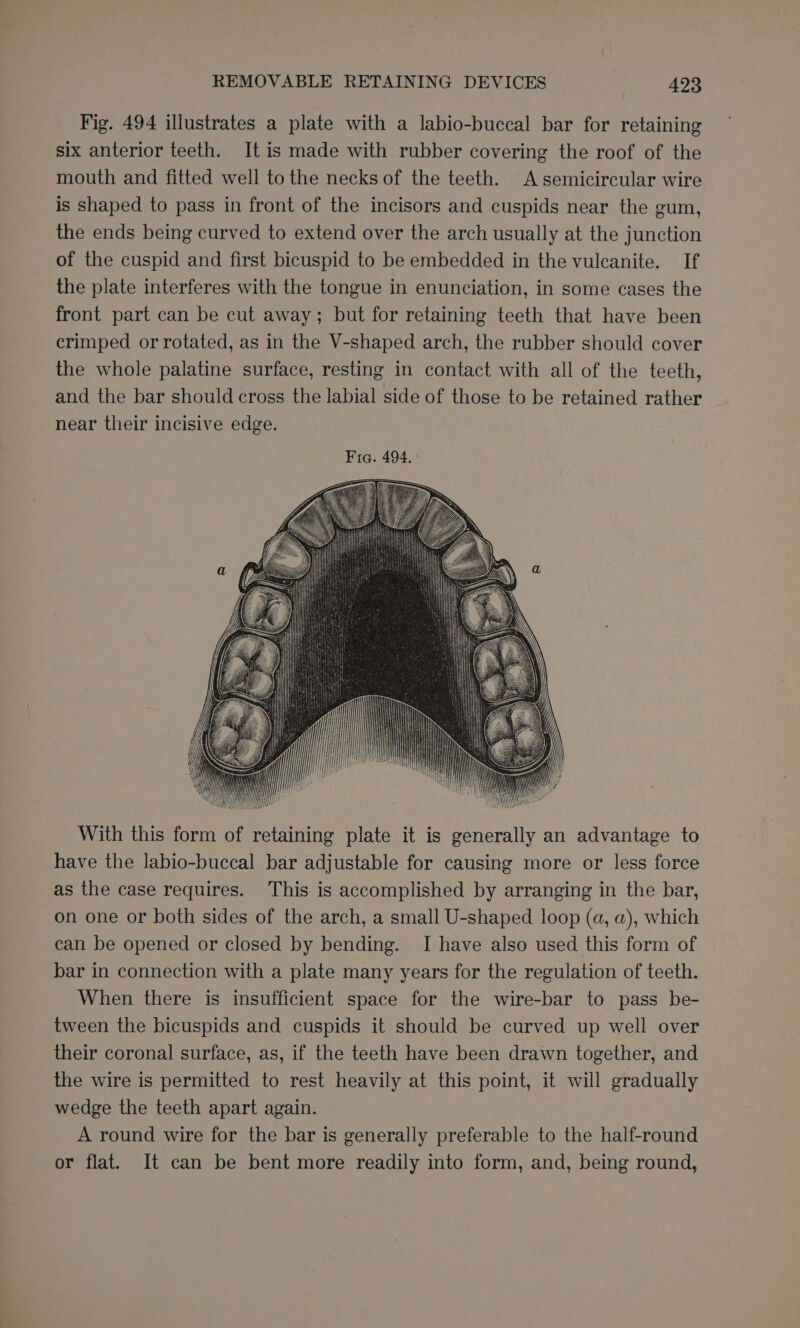 Fig. 494 illustrates a plate with a labio-buccal bar for retaining six anterior teeth. It is made with rubber covering the roof of the mouth and fitted well to the necks of the teeth. A semicircular wire is shaped to pass in front of the incisors and cuspids near the gum, the ends being curved to extend over the arch usually at the junction of the cuspid and first bicuspid to be embedded in the vulcanite. If the plate interferes with the tongue in enunciation, in some cases the front part can be cut away; but for retaining teeth that have been crimped or rotated, as in the V-shaped arch, the rubber should cover the whole palatine surface, resting in contact with all of the teeth, and the bar should cross the labial side of those to be retained rather near their incisive edge. With this form of retaining plate it is generally an advantage to have the labio-buccal bar adjustable for causing more or less force as the case requires. This is accomplished by arranging in the bar, on one or both sides of the arch, a small U-shaped loop (a, a), which can be opened or closed by bending. I have also used this form of bar in connection with a plate many years for the regulation of teeth. When there is insufficient space for the wire-bar to pass be- tween the bicuspids and cuspids it should be curved up well over their coronal surface, as, if the teeth have been drawn together, and the wire is permitted to rest heavily at this point, it will gradually wedge the teeth apart again. A round wire for the bar is generally preferable to the half-round or flat. It can be bent more readily into form, and, being round,