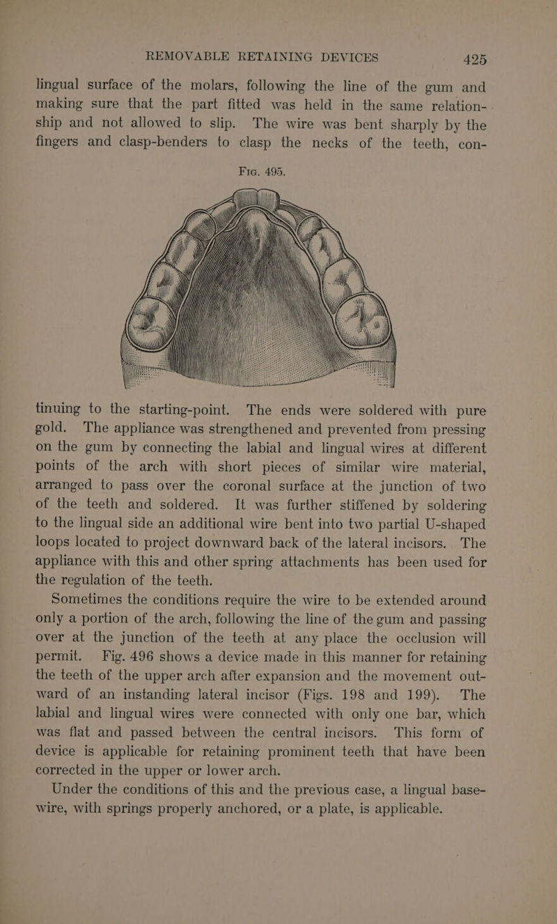 lingual surface of the molars, following the line of the gum and making sure that the part fitted was held in the same relation-. ship and not allowed to slip. The wire was bent sharply by the fingers and clasp-benders to clasp the necks of the teeth, con- tinuing to the starting-point. The ends were soldered with pure gold. The appliance was strengthened and prevented from pressing on the gum by connecting the labial and lingual wires at different points of the arch with short pieces of similar wire material, arranged to pass over the coronal surface at the junction of two of the teeth and soldered. It was further stiffened by soldering to the lingual side an additional wire bent into two partial U-shaped loops located to project downward back of the lateral incisors. The appliance with this and other spring attachments has been used for the regulation of the teeth. Sometimes the conditions require the wire to be extended around only a portion of the arch, following the line of the gum and passing over at the junction of the teeth at any place the occlusion will permit. Fig. 496 shows a device made in this manner for retaining the teeth of the upper arch after expansion and the movement out- ward of an instanding lateral incisor (Figs. 198 and 199). The labial and lingual wires were connected with only one bar, which was flat and passed between the central incisors. This form of device is applicable for retaining prominent teeth that have been corrected in the upper or lower arch. Under the conditions of this and the previous case, a lingual base- wire, with springs properly anchored, or a plate, is applicable.