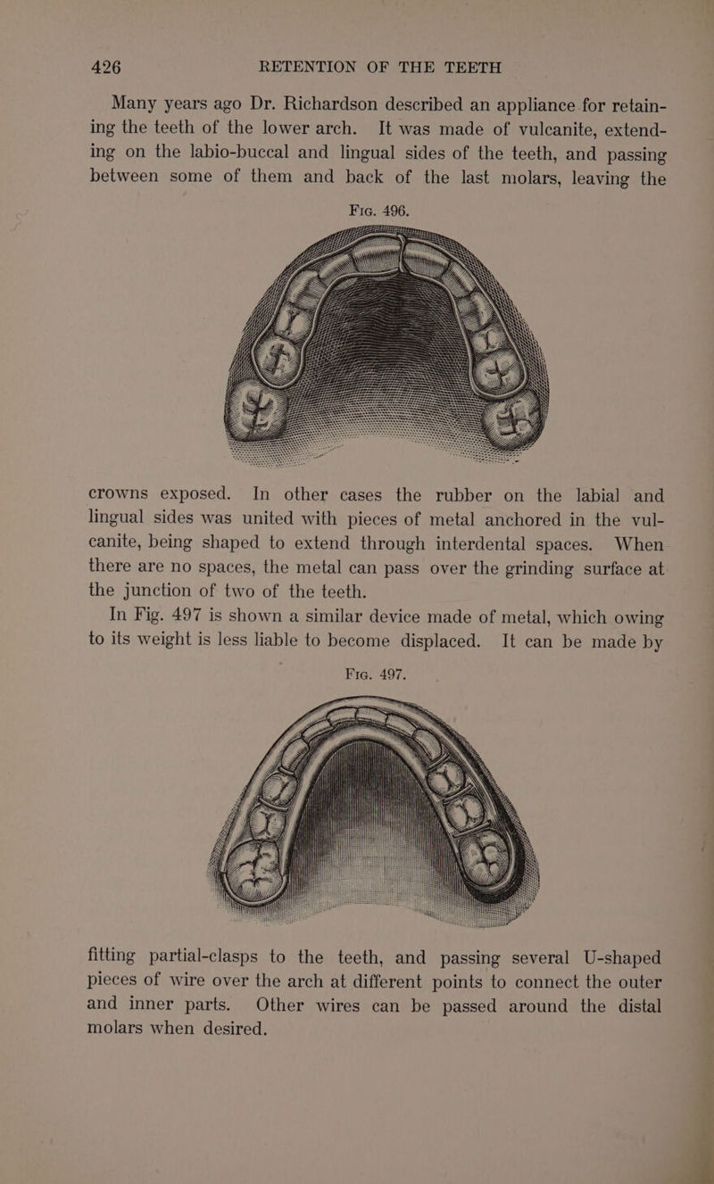 Many years ago Dr. Richardson described an appliance for retain- ing the teeth of the lower arch. It was made of vulcanite, extend- ing on the labio-buccal and lingual sides of the teeth, and passing between some of them and back of the last molars, leaving the crowns exposed. In other cases the rubber on the labial and lingual sides was united with pieces of metal anchored in the vul- canite, being shaped to extend through interdental spaces. When there are no spaces, the metal can pass over the grinding surface at the junction of two of the teeth. In Fig. 497 is shown a similar device made of metal, which owing to its weight is less liable to become displaced. It can be made by Fig. 497. fitting partial-clasps to the teeth, and passing several U-shaped pieces of wire over the arch at different points to connect the outer and inner parts. Other wires can be passed around the distal molars when desired.