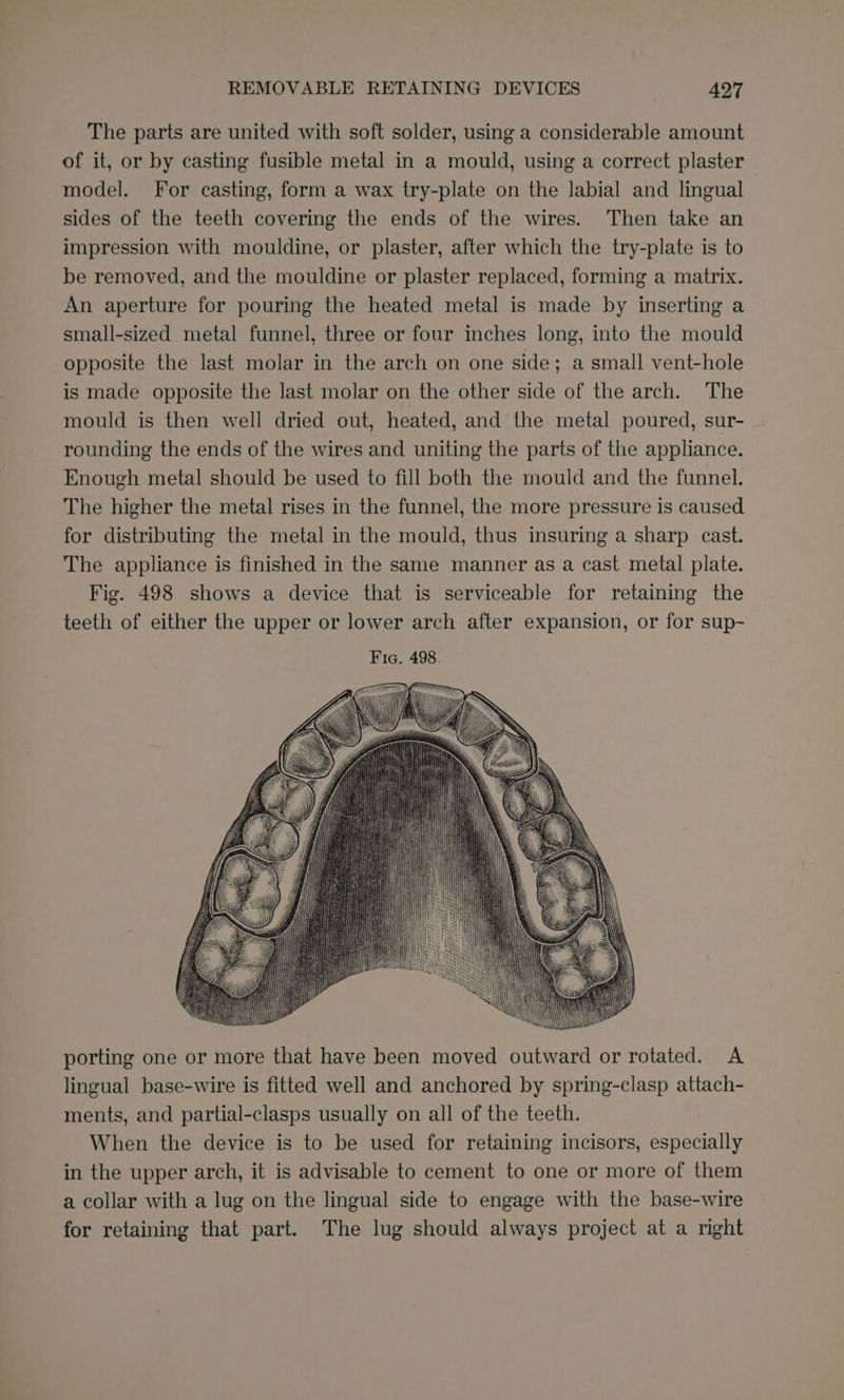 The parts are united with soft solder, using a considerable amount of it, or by casting fusible metal in a mould, using a correct plaster model. For casting, form a wax try-plate on the labial and lingual sides of the teeth covering the ends of the wires. Then take an impression with mouldine, or plaster, after which the try-plate is to be removed, and the mouldine or plaster replaced, forming a matrix. An aperture for pouring the heated metal is made by inserting a small-sized metal funnel, three or four inches long, into the mould opposite the last molar in the arch on one side; a small vent-hole is made opposite the last molar on the other side of the arch. The mould is then well dried out, heated, and the metal poured, sur- rounding the ends of the wires and uniting the parts of the appliance. Enough metal should be used to fill both the mould and the funnel. The higher the metal rises in the funnel, the more pressure is caused for distributing the metal in the mould, thus insuring a sharp cast. The appliance is finished in the same manner as a cast metal plate. Fig. 498 shows a device that is serviceable for retaining the teeth of either the upper or lower arch after expansion, or for sup- porting one or more that have been moved outward or rotated. A lingual base-wire is fitted well and anchored by spring-clasp attach- ments, and partial-clasps usually on all of the teeth. When the device is to be used for retaining incisors, especially in the upper arch, it is advisable to cement to one or more of them a collar with a lug on the lingual side to engage with the base-wire for retaining that part. The lug should always project at a right