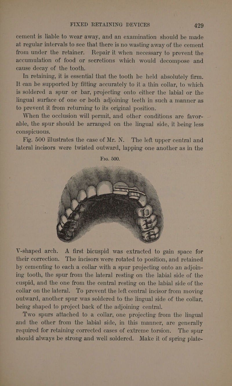 cement is liable to wear away, and an examination should be made at regular intervals to see that there is no wasting away of the cement from under the retainer. Repair it when necessary to prevent the accumulation of food or secretions which would decompose and cause decay of the tooth. In retaining, it is essential that the tooth be held absolutely firm. It can be supported by fitting accurately to it a thin collar, to which is soldered a spur or bar, projecting onto either the labial or the lingual surface of one or both adjoining teeth in such a manner as to prevent it from returning to its original position. When the occlusion will permit, and other conditions are favor- able, the spur should be arranged on the lingual side, it being less conspicuous. Fig. 500 illustrates the case of Mr. N. The left upper central and lateral incisors were twisted outward, lapping one another as in the V-shaped arch. A first bicuspid was extracted to gain space for their correction. The incisors were rotated to position, and retained by cementing to each a collar with a spur projecting onto an adjoin- ing tooth, the spur from the lateral resting on the labial side of the cuspid, and the one from the central resting on the labial side of the collar on the lateral. To prevent the left central incisor from moving outward, another spur was soldered to the lingual side of the collar, being shaped to project back of the adjoining central. Two spurs attached to a collar, one projecting from the lingual and the other from the labial side, in this manner, are generally required for retaining corrected cases of extreme torsion. The spur should always be strong and well soldered. Make it of spring plate-