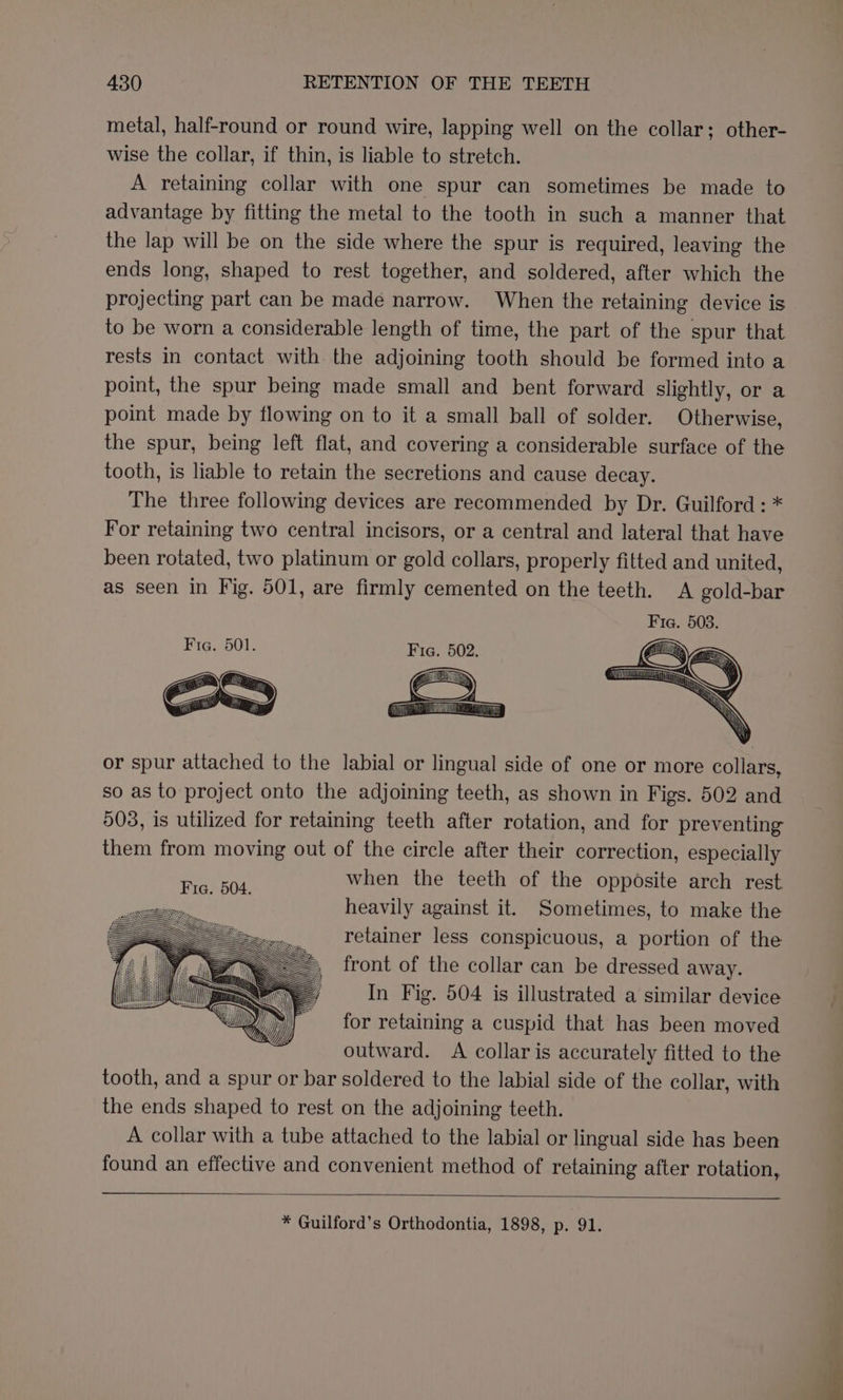 metal, half-round or round wire, lapping well on the collar; other- wise the collar, if thin, is liable to stretch. A retaining collar with one spur can sometimes be made to advantage by fitting the metal to the tooth in such a manner that the lap will be on the side where the spur is required, leaving the ends long, shaped to rest together, and soldered, after which the projecting part can be made narrow. When the retaining device is to be worn a considerable length of time, the part of the spur that rests in contact with the adjoining tooth should be formed into a point, the spur being made small and bent forward slightly, or a point made by flowing on to it a small ball of solder. Otherwise, the spur, being left flat, and covering a considerable surface of the tooth, is liable to retain the secretions and cause decay. The three following devices are recommended by Dr. Guilford : * For retaining two central incisors, or a central and lateral that have been rotated, two platinum or gold collars, properly fitted and united, as seen in Fig. 501, are firmly cemented on the teeth. A gold-bar Fia. 503. Fig. 501. Fic. 502. ally or spur attached to the labial or lingual side of one or more collars, so as to project onto the adjoining teeth, as shown in Figs. 502 and 903, is utilized for retaining teeth after rotation, and for preventing them from moving out of the circle after their correction, especially when the teeth of the opposite arch rest heavily against it. Sometimes, to make the retainer less conspicuous, a portion of the front of the collar can be dressed away. In Fig. 504 is illustrated a similar device for retaining a cuspid that has been moved outward. A collar is accurately fitted to the tooth, and a spur or bar soldered to the labial side of the collar, with the ends shaped to rest on the adjoining teeth. A collar with a tube attached to the labial or lingual side has been found an effective and convenient method of retaining after rotation, Fia. 504. * Guilford’s Orthodontia, 1898, p. 91.