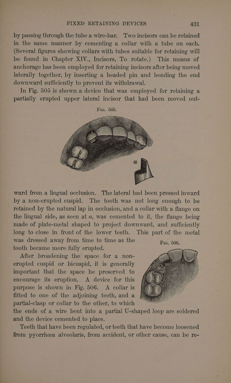 by passing through the tube a wire-bar. Two incisors can be retained in the same manner by cementing a collar with a tube on each. (Several figures showing collars with tubes suitable for retaining will be found in Chapter XIV., Incisors, To rotate.) This means of anchorage has been employed for retaining incisors after being moved laterally together, by inserting a headed pin and bending the end downward sufficiently to prevent its withdrawal. In Fig. 505 is shown a device that was employed for retaining a partially erupted upper lateral incisor that had been moved out- ward from a lingual occlusion. The lateral had been pressed inward by a non-erupted cuspid. The tooth was not long enough to be retained by the natural lap in occlusion, and a collar with a flange on the lingual side, as seen at a, was cemented to it, the flange being made of plate-metal shaped to project downward, and sufficiently long to close in front of the lower teeth. This part of the metal was dressed away from time to time as the Fra, 506. tooth became more fully erupted. After broadening the space for a non- erupted cuspid or bicuspid, it is generally important that the space be preserved to encourage its eruption. A device for this ff purpose is shown in Fig. 506. A collar is lZ 4 fitted to one of the adjoining teeth, and a yn partial-clasp or collar to the other, to which the ends of a wire bent into a partial U-shaped loop are soldered and the device cemented to place. Teeth that have been regulated, or teeth that have become loosened from pyorrhea alveolaris, from accident, or other cause, can be re-