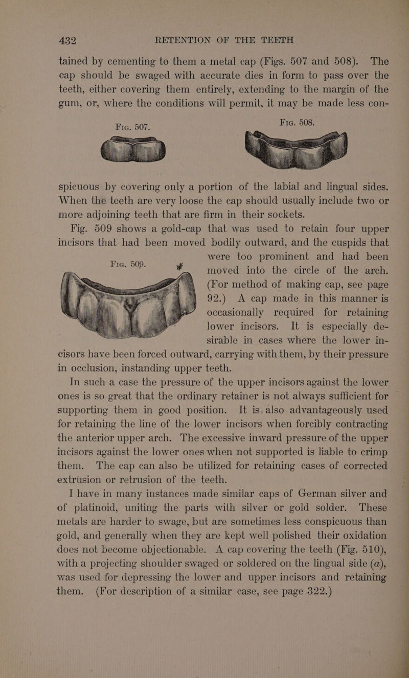 tained by cementing to them a metal cap (Figs. 507 and 508). The cap should be swaged with accurate dies in form to pass over the teeth, either covering them entirely, extending to the margin of the gum, or, where the conditions will permit, it may be made less con- spicuous by covering only a portion of the labial and lingual sides. When the teeth are very loose the cap should usually include two or more adjoining teeth that are firm in their sockets. Fig. 509 shows a gold-cap that was used to retain four upper incisors that had been moved bodily outward, and the cuspids that were too prominent and had been moved into the circle of the arch. (For method of making cap, see page 92.) A cap made in this manner is i occasionally required for retaining ¥ J Th lower incisors. It is especially de- seater sirable in cases where the lower in- cisors have been forced outward, carrying with them, by their pressure in occlusion, instanding upper teeth. In such a case the pressure of the upper incisors against the lower ones is so great that the ordinary retainer is not always sufficient for supporting them in good position. It is also advantageously used for retaining the line of the lower incisors when forcibly contracting the anterior upper arch. The excessive inward pressure of the upper incisors against the lower ones when not supported is liable to crimp them. The cap can also be utilized for retaining cases of corrected extrusion or retrusion of the teeth. I have in many instances made similar caps of German silver and of platinoid, uniting the parts with silver or gold solder. These metals are harder to swage, but are sometimes less conspicuous than gold, and generally when they are kept well polished their oxidation does not become objectionable. A cap covering the teeth (Fig. 510), with a projecting shoulder swaged or soldered on the lingual side (a), was used for depressing the lower and upper incisors and retaining them. (for description of a similar case, see page 322.)