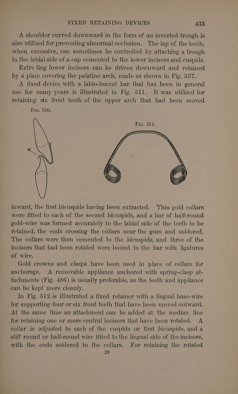 A shoulder curved downward in the form of an inverted trough is also utilized for preventing abnormal occlusion. The lap of the teeth, when excessive, can sometimes be controlled. by attaching a trough to the labial side of a cap cemented to the lower incisors and cuspids. Extru ling lower incisors can be driven downward and retained by a plate covering the palatine arch, made as shown in Fig. 337. A fixed device with a labio-buccal bar that has been in general use for many years is illustrated in Fig. 511. It was utilized for retaining six front teeth of the upper arch that had been moved inward, the first bicuspids having been extracted. Thin gold collars were fitted to each of the second bicuspids, and a bar of half-round gold-wire was formed accurately to the labial side of the teeth to be retained, the ends crossing the collars near the gum and soldered. The collars were then cemented to the bicuspids, and three of the incisors that had been rotated were bound to the bar with ligatures of wire. Gold crowns and clasps have been used in place of collars for anchorage. A removable appliance anchored with spring-clasp at- tachments (Fig. 486) is usually preferable, as the teeth and appliance can be kept more cleanly. In Fig. 512 is illustrated a fixed retainer with a lingual base-wire for supporting four or six front teeth that have been moved outward. At the same time an attachment can be added at the median line for retaining one or more central incisors that have been rotated. A collar is adjusted to each of the cuspids or first bicuspids, and a stiff round or half-round wire fitted to the lingual side of the incisors, with the ends soldered to the collars. For retaining the rotated 28