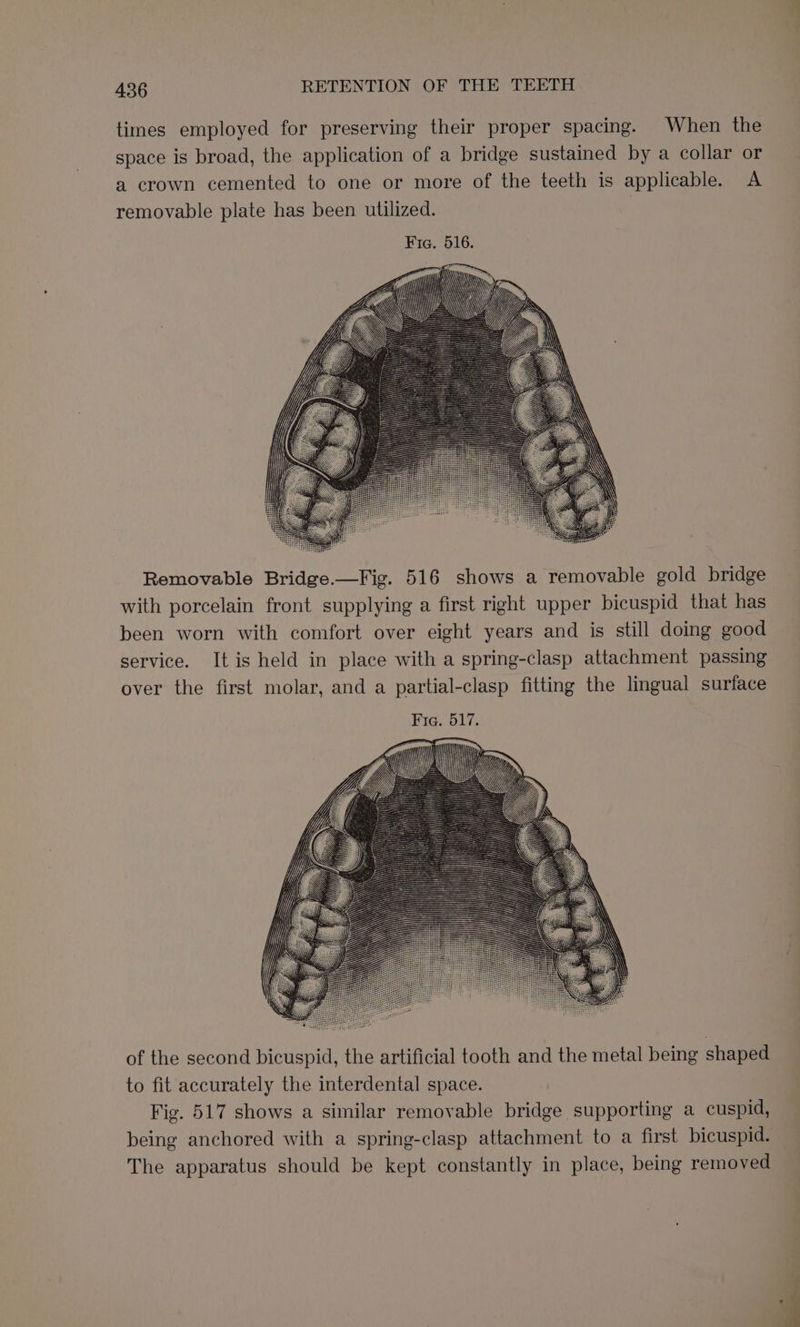 times employed for preserving their proper spacing. When the space is broad, the application of a bridge sustained by a collar or a crown cemented to one or more of the teeth is applicable. A removable plate has been utilized. | Removable Bridge.—Fig. 516 shows a removable gold bridge with porcelain front supplying a first right upper bicuspid that has been worn with comfort over eight years and is still doing good service. It is held in place with a spring-clasp attachment passing over the first molar, and a partial-clasp fitting the lingual surface Fig. 517. —_——_ of the second bicuspid, the artificial tooth and the metal being shaped to fit accurately the interdental space. Fig. 517 shows a similar removable bridge supporting a cuspid, being anchored with a spring-clasp attachment to a first bicuspid. The apparatus should be kept constantly in place, being removed