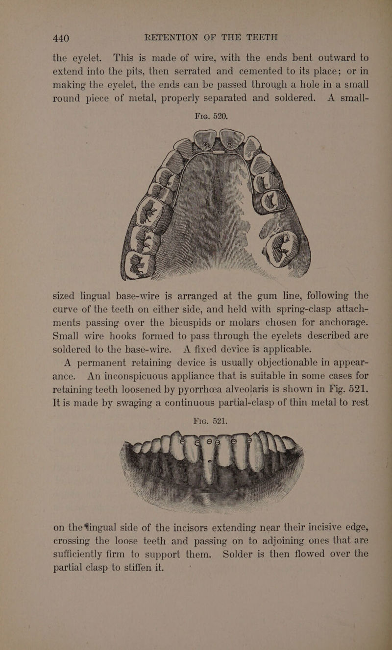 the eyelet. This is made of wire, with the ends bent outward to extend into the pits, then serrated and cemented to its place; or in making the eyelet, the ends can be passed through a hole in a small round piece of metal, properly separated and soldered. A small- sized lingual base-wire is arranged at the gum line, following the curve of the teeth on either side, and held with spring-clasp attach- ments passing over the bicuspids or molars chosen for anchorage. Small wire hooks formed to pass through the eyelets described are soldered to the base-wire. &lt;A fixed device is applicable. A permanent retaining device is usually objectionable in appear- ance. An inconspicuous appliance that is suitable in some cases for retaining teeth loosened by pyorrhecea alveolaris is shown in Fig. 521. It is made by swaging a continuous partial-clasp of thin metal to rest Fig. 621. on the 4ingual side of the incisors extending near their incisive edge, crossing the loose teeth and passing on to adjoining ones that are sufficiently firm to support them. Solder is then flowed over the partial clasp to stiffen it.