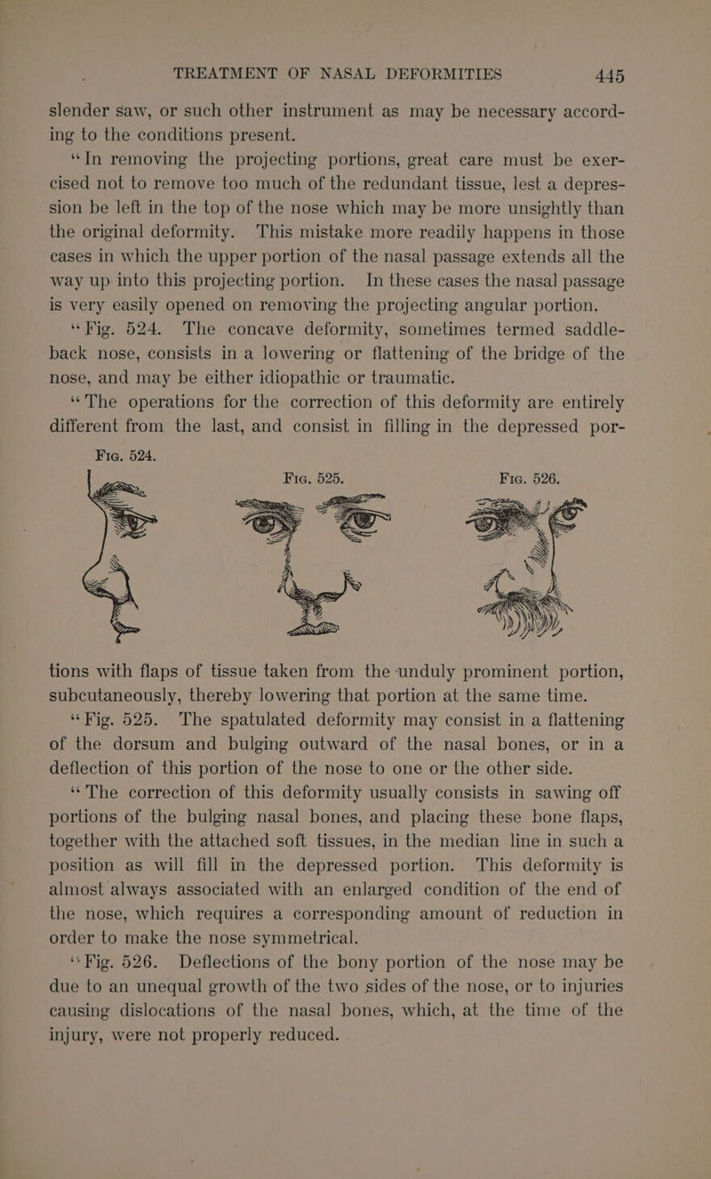 slender saw, or such other instrument as may be necessary accord- ing to the conditions present. ‘In removing the projecting portions, great care must be exer- cised not to remove too much of the redundant tissue, lest a depres- sion be left in the top of the nose which may be more unsightly than the original deformity. This mistake more readily happens in those cases in which the upper portion of the nasal passage extends all the way up into this projecting portion. In these cases the nasal passage is very easily opened on removing the projecting angular portion. ‘Hig, 524. The concave deformity, sometimes termed saddle- back nose, consists in a lowering or flattening of the bridge of the nose, and may be either idiopathic or traumatic. “The operations for the correction of this deformity are entirely different from the last, and consist in filling in the depressed por- Fie. 525. fi tions with flaps of tissue taken from the unduly prominent portion, subcutaneously, thereby lowering that portion at the same time. “Fig, 525. The spatulated deformity may consist in a flattening of the dorsum and bulging outward of the nasal bones, or in a deflection of this portion of the nose to one or the other side. ‘*The correction of this deformity usually consists in sawing off portions of the bulging nasal bones, and placing these bone flaps, together with the attached soft tissues, in the median line in such a position as will fill in the depressed portion. This deformity is almost always associated with an enlarged condition of the end of the nose, which requires a corresponding amount of reduction in order to make the nose symmetrical. “ Fig, 526. Deflections of the bony portion of the nose may be due to an unequal growth of the two sides of the nose, or to injuries causing dislocations of the nasal bones, which, at the time of the injury, were not properly reduced.