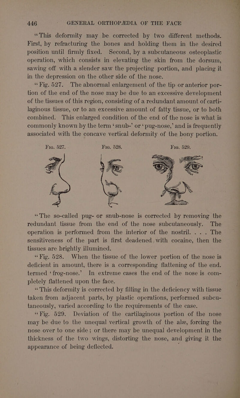 ‘This deformity may be corrected by two different methods. First, by refracturing the bones and holding them in the desired position until firmly fixed. Second, by a subcutaneous osteoplastic operation, which consists in elevating the skin from the dorsum, sawing off with a slender saw the projecting portion, and placing it in the depression on the other side of the nose. ‘Hig. 527. The abnormal enlargement of the tip or anterior por- tion of the end of the nose may be due to an excessive development of the tissues of this region, consisting of a redundant amount of carti- laginous tissue, or to an excessive amount of fatty tissue, or to both combined. This enlarged condition of the end of the nose is what is commonly known by the term ‘snub-’ or ‘ pug-nose,’ and is frequently associated with the concave vertical deformity of the bony portion. ‘The so-called pug- or snub-nose is corrected by removing the redundant tissue from the end of the nose subcutaneously. The operation is performed from the interior of the nostril. . . . The sensitiveness of the part is first deadened with cocaine, then the tissues are brightly illumined. ‘Hig, 528. When the tissue of the lower portion of the nose is deficient in amount, there is a corresponding flattening of the end. termed ‘frog-nose.’ In extreme cases the end of the nose is com- pletely flattened upon the face. ‘This deformity is corrected by filling in the deficiency with tissue taken from adjacent parts, by plastic operations, performed subcu- taneously, varied according to the requirements of the case. “Fig, 529. Deviation of the cartilaginous portion of the nose may be due to the unequal vertical growth of the ale, forcing the nose over to one side; or there may be unequal development in the thickness of the two wings, distorting the nose, and giving it the appearance of being deflected.