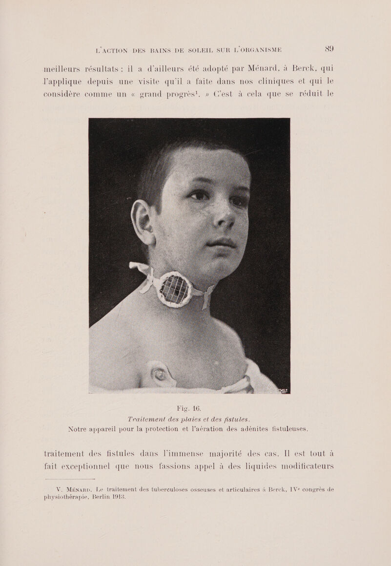 meilleurs résultats : il a d’ailleurs été adopté par Ménard, à Berck, qui l’applique depuis une visite qu'il a faite dans nos cliniques et qui le considère comme un « grand progrès!. » C'est à cela que se réduit le Ln) traitement des fistules dans l’immense majorité des cas. I est tout à fait exceptionnel que nous fassions appel à des liquides modificateurs V. Ménaro, Le traitement des tuberculoses osseuses et articulaires à Berck, IVe congrès de physiothérapie, Berlin 1913.