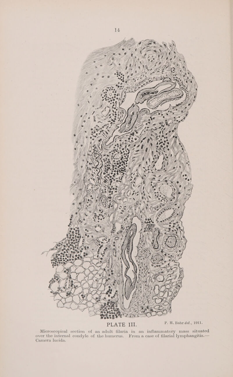 Sas A : P. H. Bahr del., 1911. PUATE SLL of an adult fil aria in an inflammatory mass situated From a case of filarial lymphangitis. over the internal condyle of the humerus. Camera lucida. section Microscopical