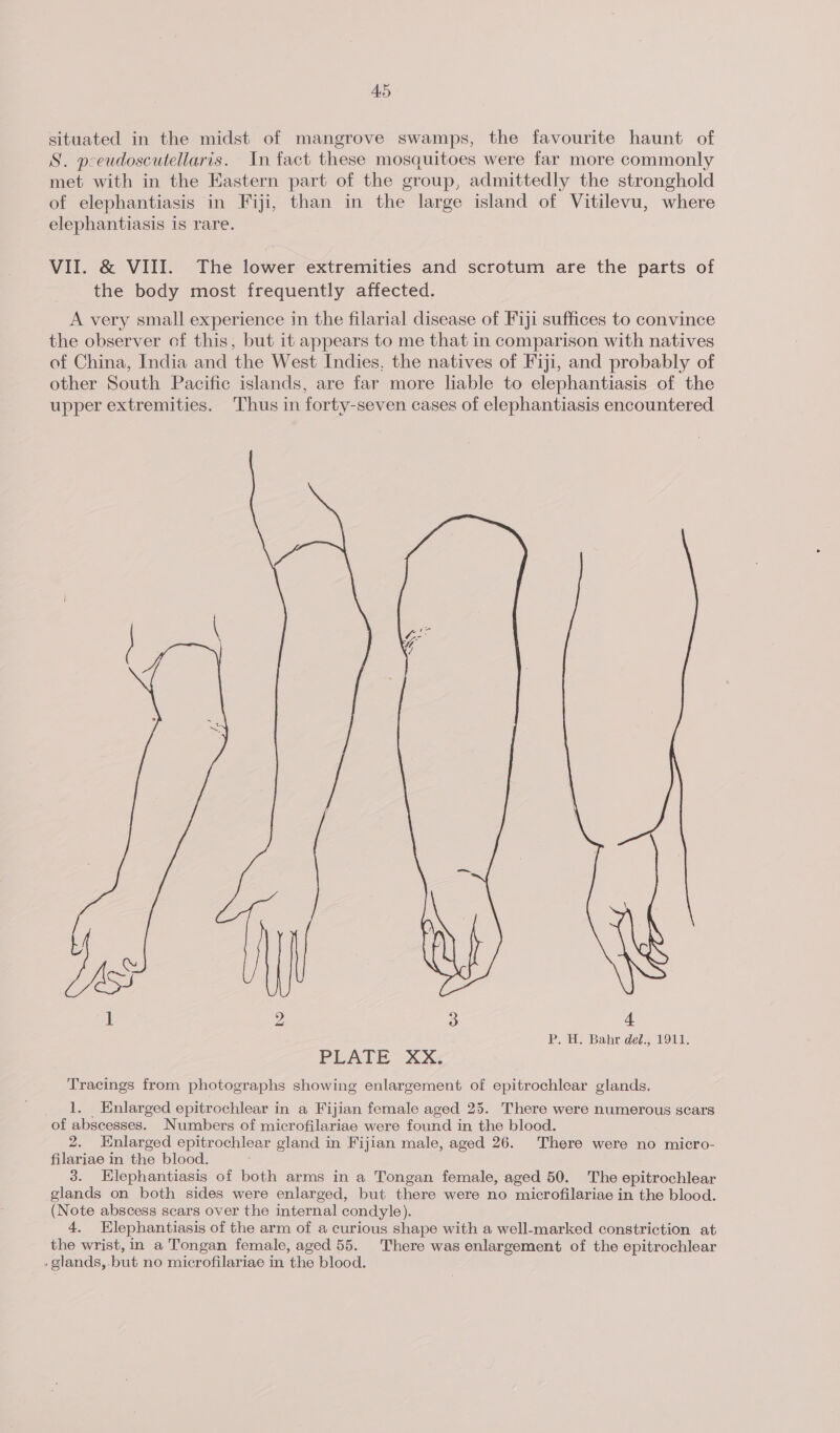 AS situated in the midst of mangrove swamps, the favourite haunt of S. pcoeudoscutellaris. In fact these mosquitoes were far more commonly met with in the Eastern part of the group, admittedly the stronghold of elephantiasis in Fiji, than in the large island of Vitilevu, where elephantiasis is rare. VII. &amp; VIII. The lower extremities and scrotum are the parts of the body most frequently affected. A very small experience in the filarial disease of Fiji suffices to convince the observer of this, but it appears to me that in comparison with natives of China, India and the West Indies, the natives of Fiji, and probably of other South Pacific islands, are far more liable to elephantiasis of the upper extremities. Thus in forty-seven cases of elephantiasis encountered : 2 3 4 P. H. Bahr de?., 1911. PLATE-X xX Tracings from photographs showing enlargement of epitrochlear glands. 1. Enlarged epitrochlear in a Fijian female aged 25. There were numerous scars of abscesses. Numbers of microfilariae were found in the blood. 2. Enlarged epitrochlear gland in Fijian male, aged 26. There were no micro- filariae in the blood. 3. Hlephantiasis of both arms in a Tongan female, aged 50. The epitrochlear glands on both sides were enlarged, but there were no microfilariae in the blood. (Note abscess scars over the internal condyle). 4, Elephantiasis of the arm of a curious shape with a well-marked constriction at the wrist, in a Tongan female, aged 55. There was enlargement of the epitrochlear .glands,.but no microfilariae in the blood.