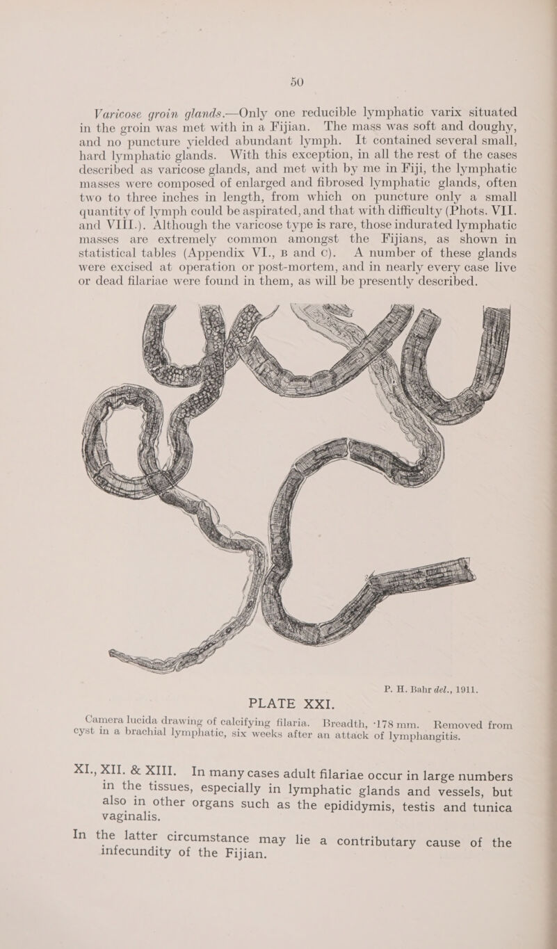 ‘cose groin glands.—Only one reducible lymphatic varix situated in ie saiceiy He with in Fijian. The mass was soft and cae and no puncture yielded abundant lymph. It contained several small, hard lymphatic glands. With this exception, in all the rest of the cases described as varicose glands, and met with by me in Fiji, the lymphatic masses were composed of cee Si and ae pene eae gee three inches in length, from which on puncture on es of lymph could Le aamrnted and that with difficulty (Phots. VI. and VIII.). Although the varicose type is rare, those indurated lymphatic masses are extremely common amongst the Fijians, as shown in statistical tables (Appendix VI., B and c). A number of these glands were excised at operation or post-mortem, and in nearly every case live or dead filariae were found in them, as will be presently described. PLATES XX: Camera lucida drawing of calcifying filaria. Breadth, ‘178 mm. _ Removed from cyst in a brachial lymphatic, six weeks after an attack of lymphangitis. XI, XI. &amp; XIII. In many cases adult filariae occur in large numbers in the tissues, especially in lymphatic glands and vessels, but also in other organs such as the epididymis, testis and tunica vaginalis. In the latter circumstance may lie a contributary cause of the infecundity of the Fijian.