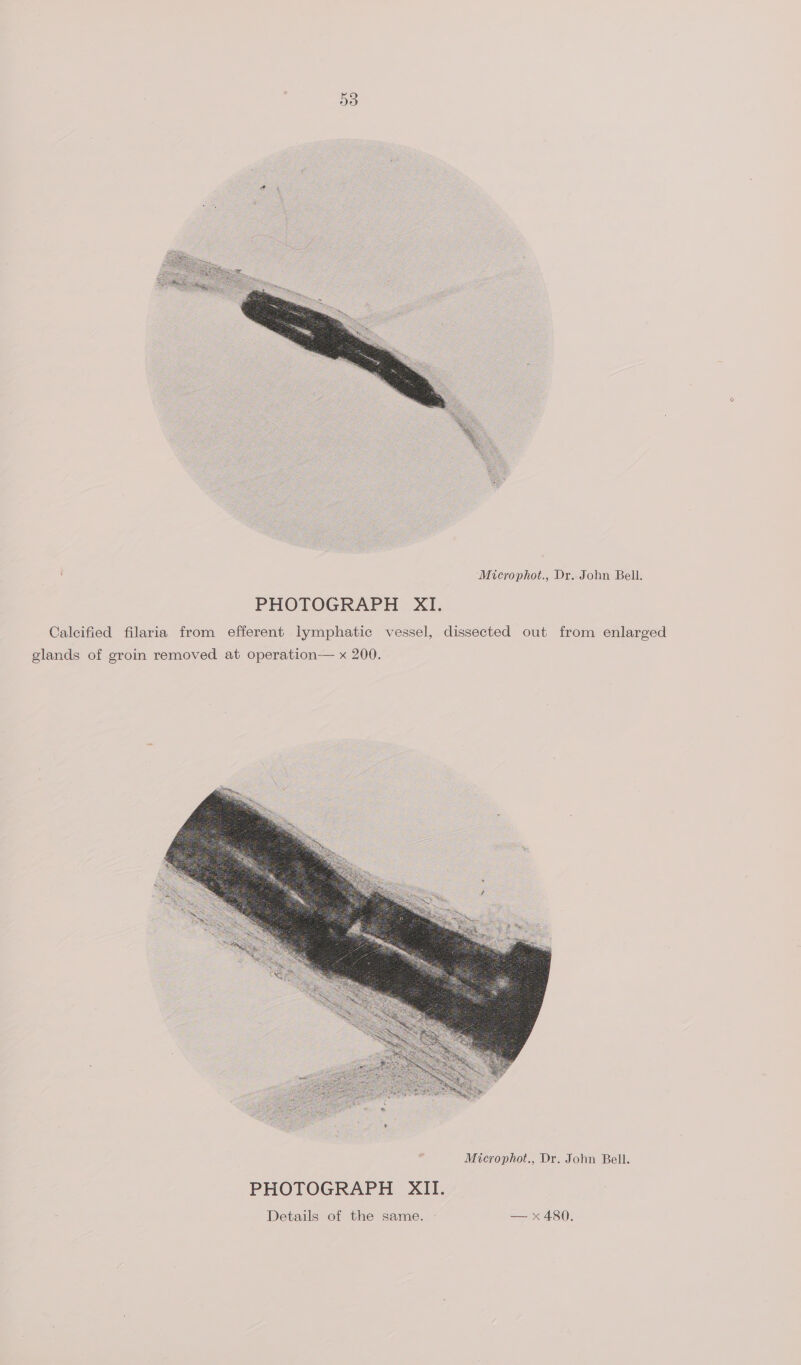 Microphot., Dr. John Bell. PHOTOGRAPH XI. Calcified filaria from efferent lymphatic vessel, dissected out from enlarged glands of groin removed at operation— x 200. Microphot., Dr. John Bell.