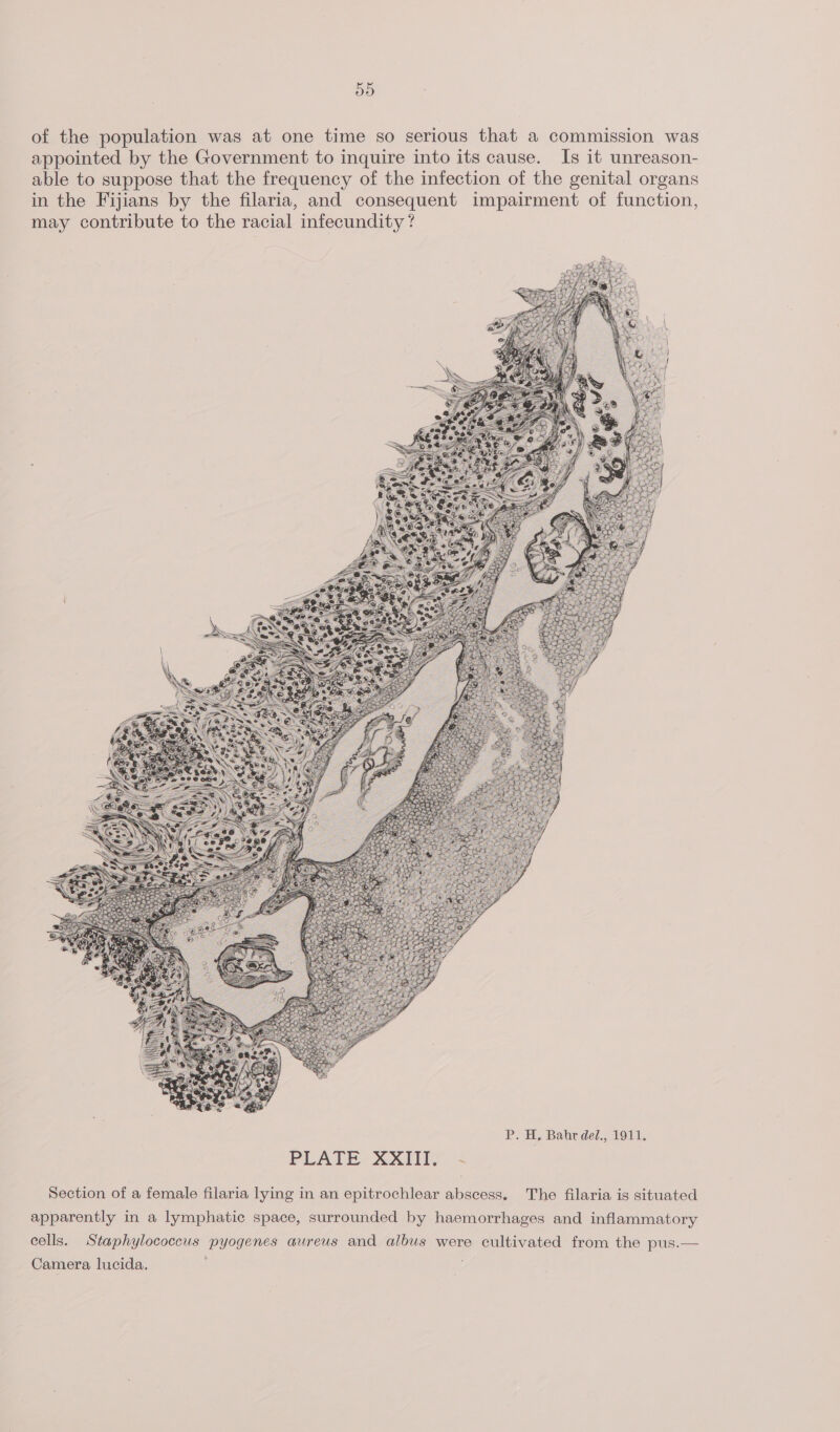 a) of the population was at one time so serious that a commission was appointed by the Government to inquire into its cause. Is it unreason- able to suppose that the frequency of the infection of the genital organs in the Fijians by the filaria, and consequent impairment of function, may contribute to the racial infecundity ? PLATE XXfily *= Section of a female filaria lying in an epitrochlear abscess. The filaria is situated apparently in a lymphatic space, surrounded by haemorrhages and inflammatory cells. Staphylococcus pyogenes aureus and albus were cultivated from the pus.— Camera lucida. ;