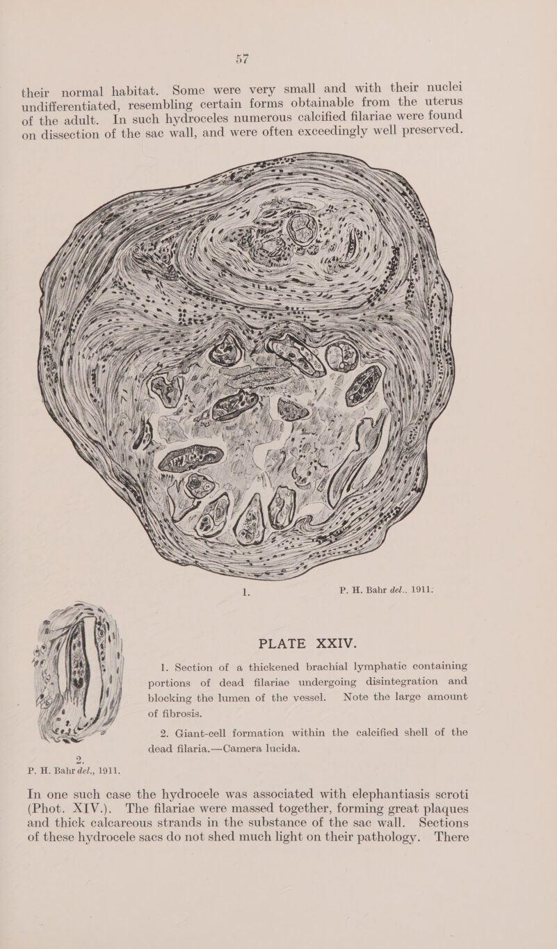 their normal habitat. Some were very small and with their nuclei undifferentiated, resembling certain forms obtainable from the uterus of the adult. In such hydroceles numerous calcified filariae were found on dissection of the sac wall, and were often exceedingly well preserved. I. P. H. Bahr del., 1911: PLATE XXIV. 1. Section of a thickened brachial lymphatic containing portions of dead filariae undergoing disintegration and blocking the lumen of the vessel. Note the large amount of fibrosis. 2. Giant-cell formation within the calcified shell of the dead filaria.—Camera lucida. P. H. Bahr del., 1911. In one such case the hydrocele was associated with elephantiasis scroti (Phot. XIV.). The filariae were massed together, forming great plaques and thick caleareous strands in the substance of the sac wall. Sections of these hydrocele sacs do not shed much light on their pathology. There