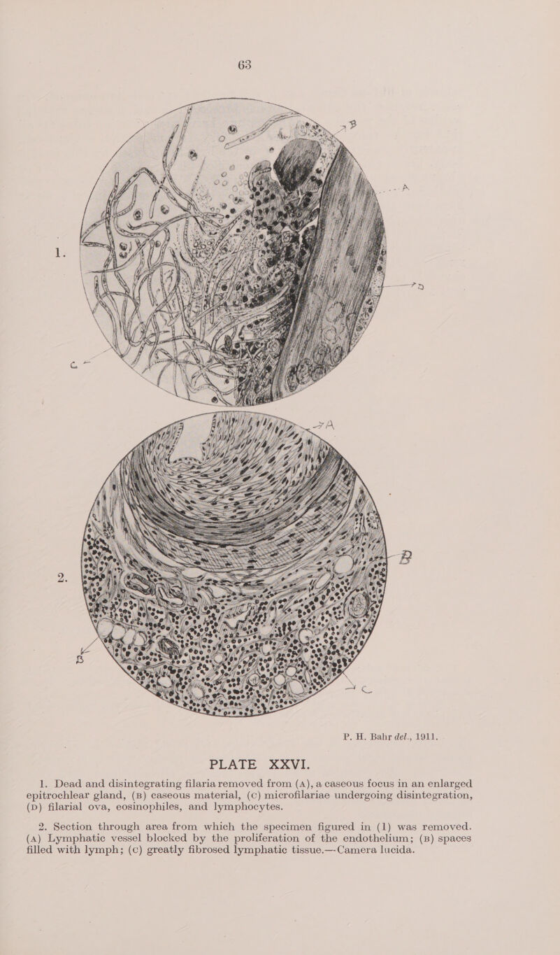 Pane Bahmdes Lola: 1. Dead and disintegrating filaria removed from (A), a caseous focus in an enlarged epitrochlear gland, (B) caseous material, (c) microfilariae undergoing disintegration, (D) filarial ova, eosinophiles, and lymphocytes. 2. Section through area from which the specimen figured in (1) was removed. (4) Lymphatic vessel blocked by the proliferation of the endothelium; (B) spaces filled with lymph; (c) greatly fibrosed lymphatic tissue.—-Camera lucida.