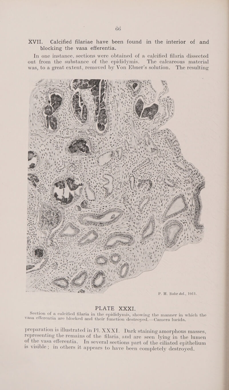 XVII. Calcified filariae have been found in the interior of and blocking the vasa efferentia. , In one instance, sections were obtained of a calcified filaria dissected , out from the substance of the epididymis. The calcareous material was, to a great extent, removed by Von Ebner’s solution. The resulting ee NE Ca or tye sere SC uF , DAS Ca ss P. H. Bahr ded., 1911. PLATE XOGXT: ~, | s Laat . . . . . . . . Section of a calcified filaria in the epididymis, showing the manner in which the vasa efferentia are blocked and their function destroyed.—Camera lucida. preparation is illustrated in Pl. XX XI. Dark staining amorphous masses, iin ee the remains of the filaria, and are seen lying in the lumen of the vasa efferentia. In several sections part of the ciliated epithelium is visible; in others it appears to have been completely destroyed.