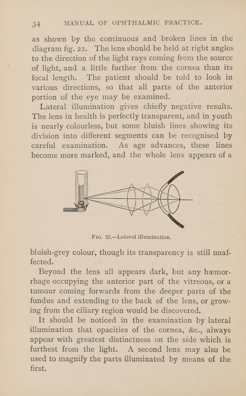 as shown by the continuous and broken lines in the diagram fig. 22. The lens should be held at right angles to the direction of the light rays coming from the source of light, and a little further from the cornea than its focal length. The patient should be told to look in various directions, so that all parts of the anterior portion of the eye may be examined. Lateral illumination gives chiefly negative results. The lens in health is perfectly transparent, and in youth is nearly colourless, but some bluish lines showing its division into different segments can be recognised by careful examination. As age advances, these lines become more marked, and the whole lens appears of a bluish-grey colour, though its transparency is still unaf- fected. Beyond the lens all appears dark, but any hezmor- rhage occupying the anterior part of the vitreous, or a tumour coming forwards from the deeper parts of the fundus and extending to the back of the lens, or grow- ing from the ciliary region would be discovered. It should be noticed in the examination by lateral illumination that opacities of the cornea, &amp;c., always appear with greatest distinctness on the side which is furthest from the light. A second lens may also be used to magnify the parts illuminated by means of the first.