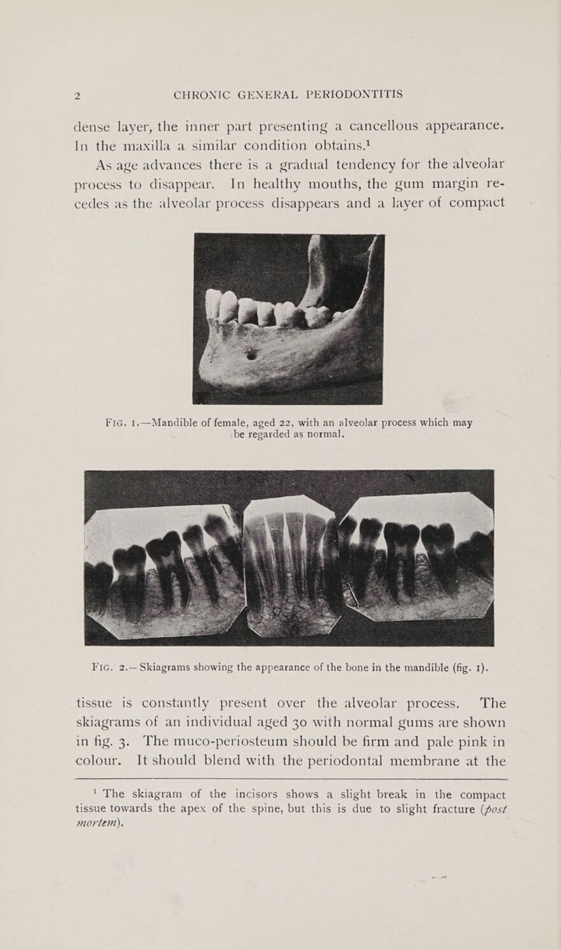 dense layer, the inner part presenting a cancellous appearance. In the maxilla a similar condition obtains.? As age advances there is a gradual tendency for the alveolar process to disappear. In healthy mouths, the gum margin re- cedes as the alveolar process disappears and a layer of compact Fic. 1.—Mandible of female, aged 22, with an alveolar process which may ibe regarded as normal. tissue is constantly present over the alveolar process. The skiagrams of an individual aged 30 with normal gums are shown in fig. 3. The muco-periosteum should be firm and _ pale pink in colour. It should blend with the periodontal membrane at the ' The skiagram of the incisors shows a slight break in the compact tissue towards the apex of the spine, but this is due to slight fracture (fos¢ mortem).