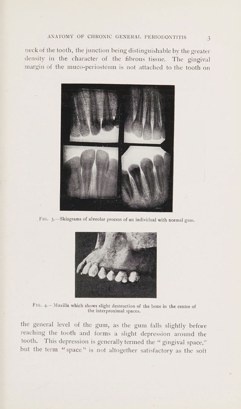 neck of the tooth, the junction being distinguishable by the greater density in the character of the fibrous tissue. The gingival margin of the muco-periosteum is not attached to the tooth on Fic. 3.—Skiagrams of alveolar process of an individual with normal gum. Fic. 4.--Maxilla which shows slight destruction of the bone in the centre of the interproximal spaces. the general level of the gum, as the gum falls slightly before reaching the tooth and forms a slight depression around the tooth. This depression is generally termed the “ gingival space,” but the term “space” is not altogether satisfactory as the soft