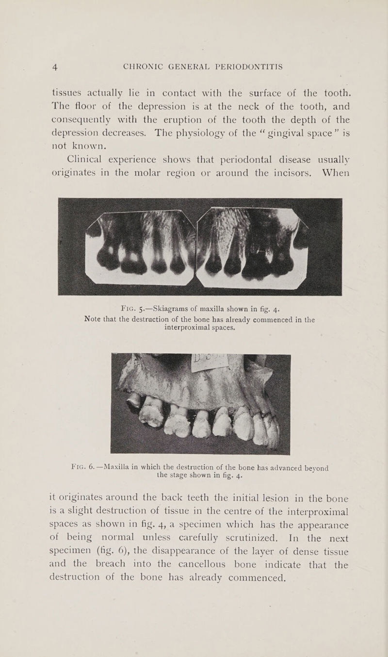 tissues actually lie in contact with the surface of the tooth. The floor of the depression is at the neck of the tooth, and consequently with the eruption of the tooth the depth of the depression decreases. The physiology of the “ gingival space ” is not known. Clinical experience shows that periodontal disease usually originates in the molar region or around the incisors. When Fic. 5.—Skiagrams of maxilla shown in fig. 4. Note that the destruction of the bone has already commenced in the interproximal spaces. Fic. 6.—Maxilla in which the destruction of the bone has advanced beyond the stage shown in fig. q. it originates around the back teeth the initial lesion in the bone is a slight destruction of tissue in the centre of the interproximal spaces as shown in fig. 4, a specimen which has the appearance of being normal unless carefully scrutinized. In the next specimen (fig. 6), the disappearance of the layer of dense tissue and the breach into the cancellous bone indicate that the destruction of the bone has already commenced.