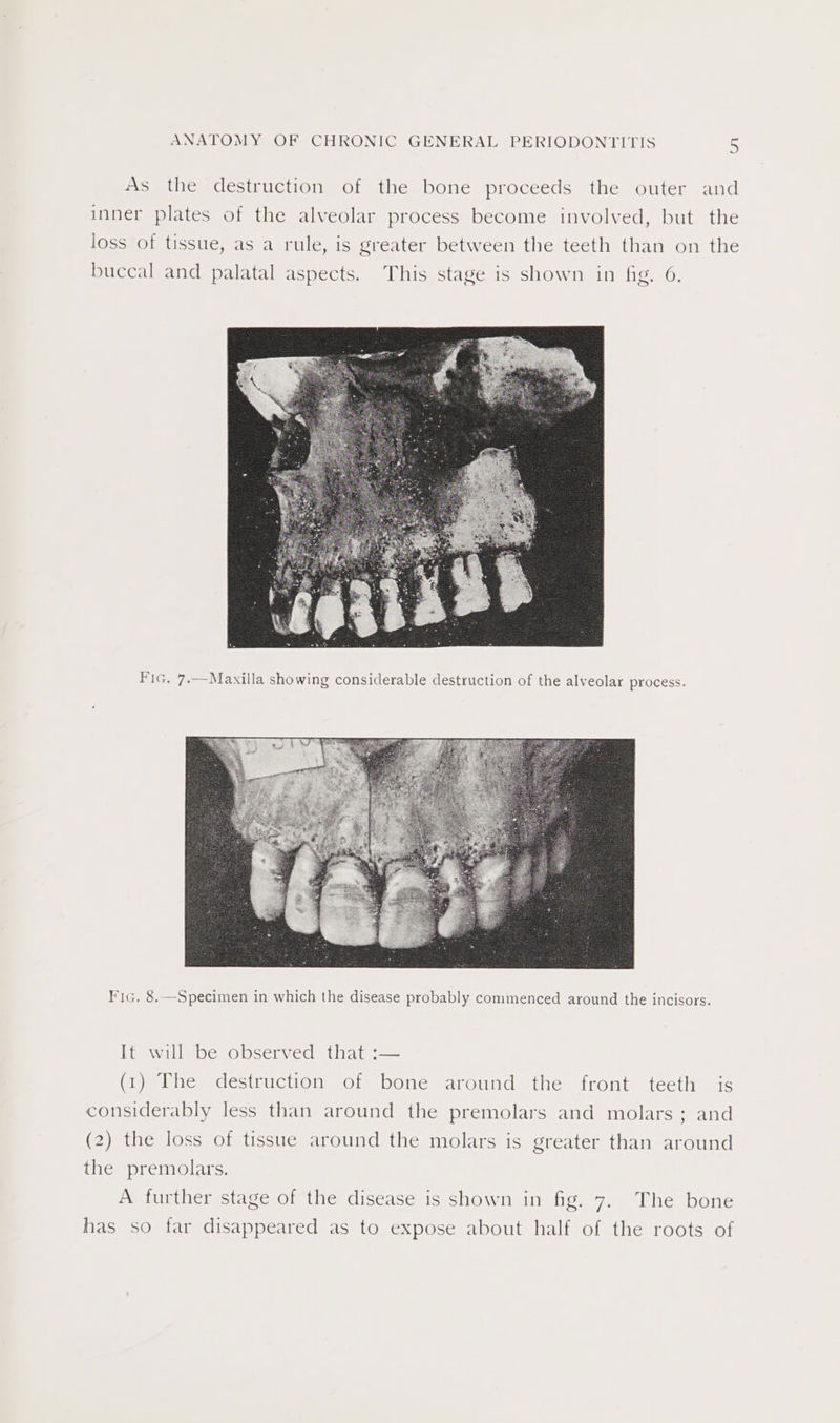 As the destruction of the bone proceeds the outer and inner plates of the alveolar process become involved, but the loss of tissue, as a rule, is greater between the teeth than on the buccal and palatal aspects. This stage is shown in fig. 6. Fic. 8.—Specimen in which the disease probably commenced around the incisors. It will be observed that :— (1) The destruction of bone around the front teeth is considerably less than around the premolars and molars; and (2) the loss of tissue around the molars is greater than around the premolars. A further stage of the disease is shown in fig. 7. The bone has so far disappeared as to expose about half of the roots of