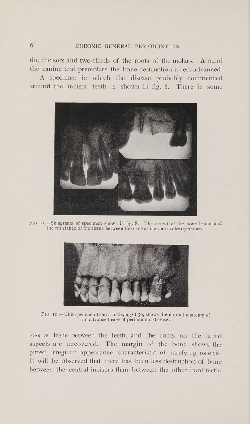 the incisors and two-thirds of the roots of the molars. Around the canine and premolars the bone destruction is less advanced. A specimen in which the disease probably commenced around the incisor teeth is shown in fig. 8. There is some Fic. 9.—Skiagrams of specimen shown in fig. 8. The extent of the bone lesion and the resistance of the tissue between the central incisors is clearly shown. Fic. 10.—This specimen from a male, aged 30, shows the morbid anatomy of an advanced case of periodontal disease. loss of bone between the teeth, and the roots on the labial aspects are uncovered. The margin of the bone shows the pitted, irregular appearance characteristic of rarefying osteitis. It will be observed that there has been less destruction of bone between the central incisors than between the other front teeth.