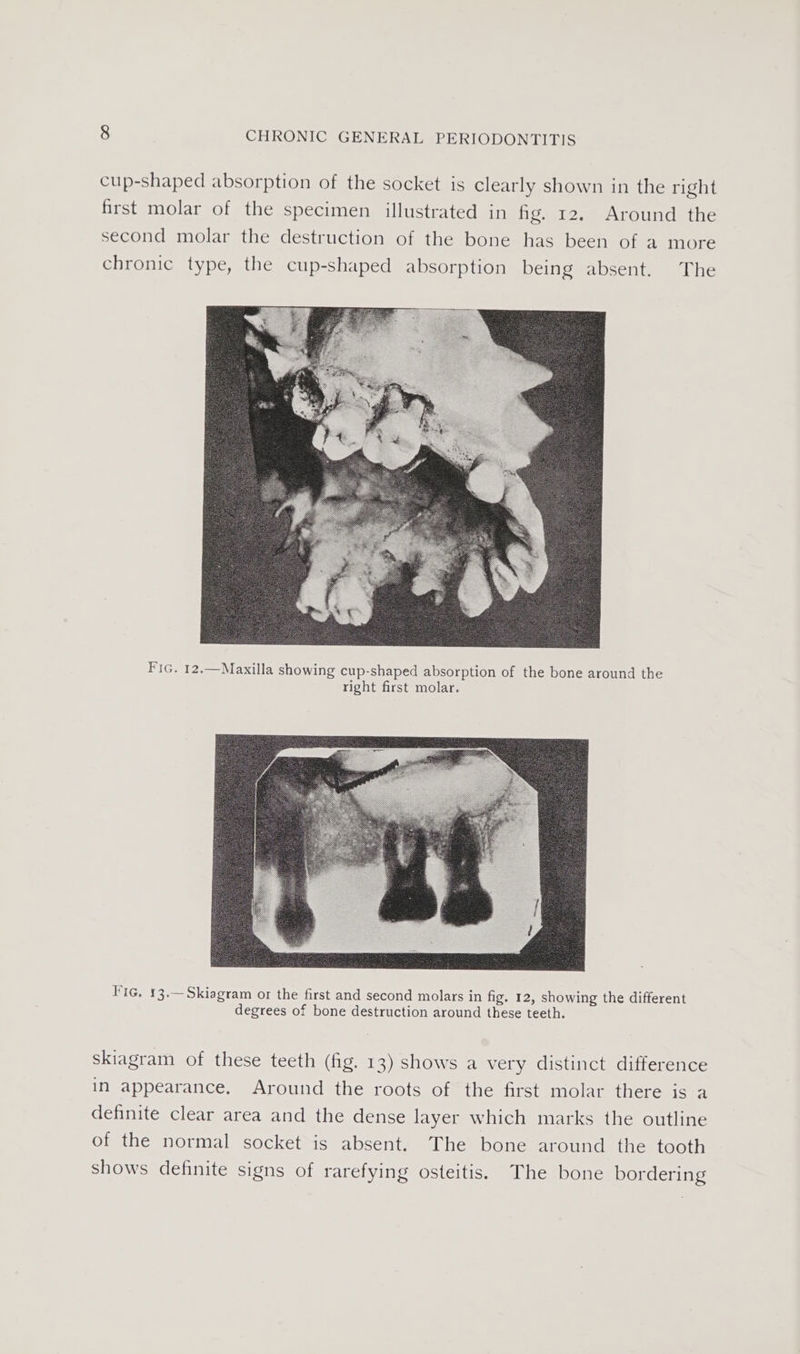 cup-shaped absorption of the socket is clearly shown in the right first molar of the specimen illustrated in hg. 12. Around the second molar the destruction of the bone has been of a more chronic type, the cup-shaped absorption being absent. The FiG. 12.—Maxilla showing cup-shaped absorption of the bone around the right first molar. Fic. 13.—Skiagram or the first and second molars in fig. 12, showing the different degrees of bone destruction around these teeth. skiagram of these teeth (fig. 13) shows a very distinct difference in appearance, Around the roots of the first molar there is a definite clear area and the dense layer which marks the outline of the normal socket is absent. The bone around the tooth shows definite signs of rarefying osteitis. The bone bordering