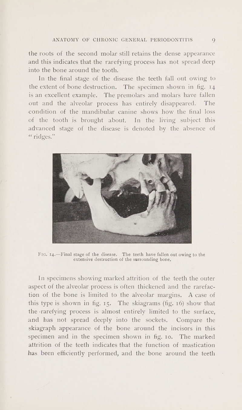 the roots of the second molar still retains the dense appearance and this indicates that the rarefying process has not spread deep into the bone around the tooth. In the final stage of the disease the teeth fall out owing to the extent of bone destruction. The specimen shown in fig. 14 is an excellent example. The premolars and molars have fallen out and the alveolar process has entirely disappeared. The condition of the mandibular canine shows how the final loss Clg UiGmlOOUmicr DLOUChL = 2aboOutessine thes living subject tis advanced stage of the disease is denoted by the absence of s ridgess Fic. 14.—Final stage of the disease. The teeth have fallen out owing to the extensive destruction of the surrounding bone, In specimens showing marked attrition of the teeth the outer aspect of the alveolar process is often thickened and the rarefac- tion of the bone is limited to the alveolar margins. A case of this type is shown in fig. 15. The skiagrams (fig. 16) show that the :rarefying process is almost entirely limited to the surface, and has not spread deeply into the sockets. Compare the skiagraph appearance of the bone around the incisors in this specimen and in the specimen shown in fig. 10. The marked attrition of the teeth indicates that the function of mastication has been efficiently performed, and the bone around the teeth