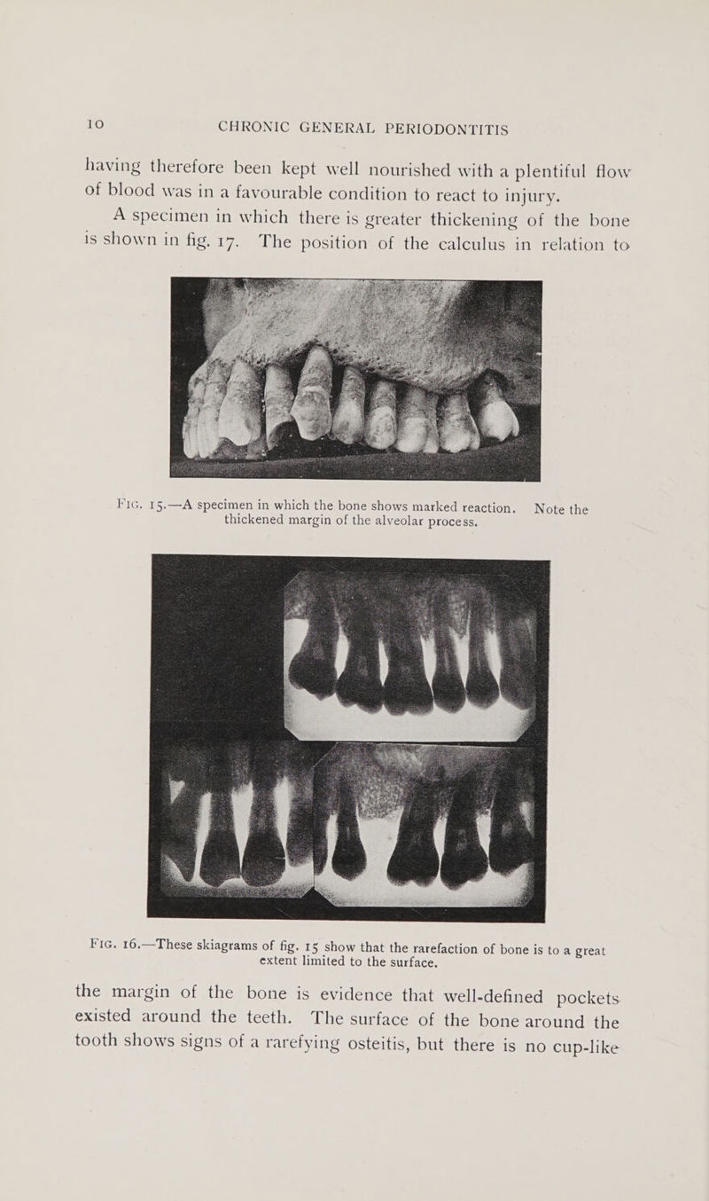 having therefore been kept well nourished with a plentiful flow of blood was in a favourable condition to react to injury. A specimen in which there is greater thickening of the bone is shown in fig. 17. The position of the calculus in relation to FIG, 15.—A specimen in which the bone shows marked reaction. Note the thickened margin of the alveolar process. Fic. 16.—These skiagrams of fig. 15 show that the rarefaction of bone is toa great extent limited to the surface. the margin of the bone is evidence that well-defined pockets existed around the teeth. The surface of the bone around the tooth shows signs of a rarefying osteitis, but there is no cup-like