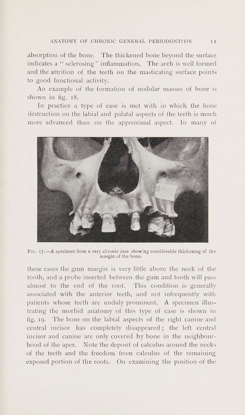 absorption of the bone. The thickened bone beyond the surface ” indicates a ‘‘ sclerosing” inflammation. The arch is well formed and the attrition of the teeth on the masticating surface points to good functional activity. An example of the formation of nodular masses of bone is shown in fig. 18. Ine pra clicesae types Olscacenise met with ine which the bone destruction on the labial and palatal aspects of the teeth is much more advanced than on the approximal aspect. In many of Fic. 17.—A specimen from a very chronic case showing considerable thickening of the margin of the bone. these cases the gum margin is very little above the neck of the tooth, and a probe inserted between the gum and tooth will pass almost to the end of the root. This condition is generally associated with the anterior teeth, and not infrequently with patients whose teeth are unduly prominent. A specimen illus- trating the morbid anatomy of this type of case is shown in fig. 19. Lhe bone onthe labial aspects of the right canine and cCential incisor sas completely: disappeared ; “the jeft~ central incisor and canine are only covered by bone in the neighbour- hood of the apex. Note the deposit of calculus around the necks ef the teeth and the freedom trom calculus of the temaining exposed portion of the roots. On examining the position of the