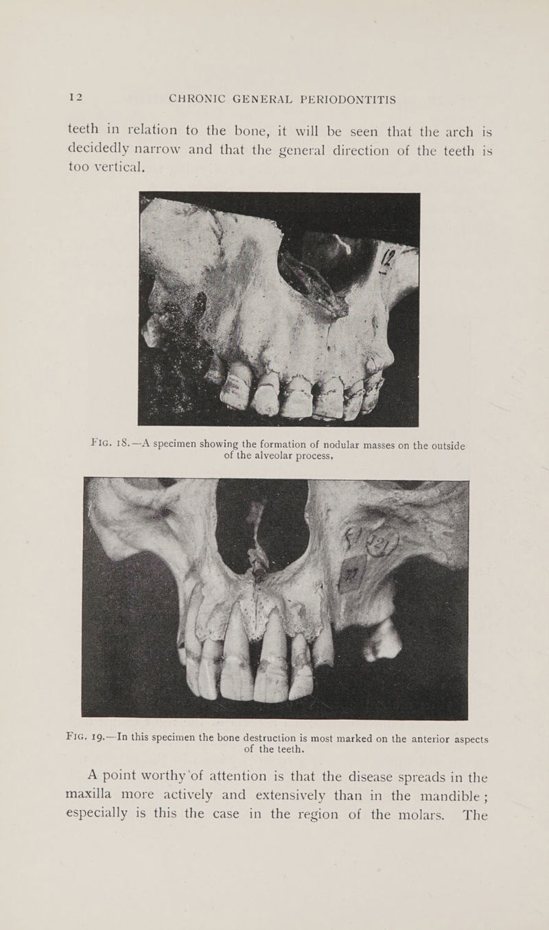 teeth in relation to the bone, it will be seen that the arch is decidedly narrow and that the general direction of the teeth is too vertical. Fic. 18.—A specimen showing the formation of nodular masses on the outside of the alveolar process. FIG. 19.—In this specimen the bone destruction is most marked on the anterior aspects of the teeth. A point worthy of attention is that the disease spreads in the maxilla more actively and extensively than in the mandible; especially is this the case in the region of the molars. The