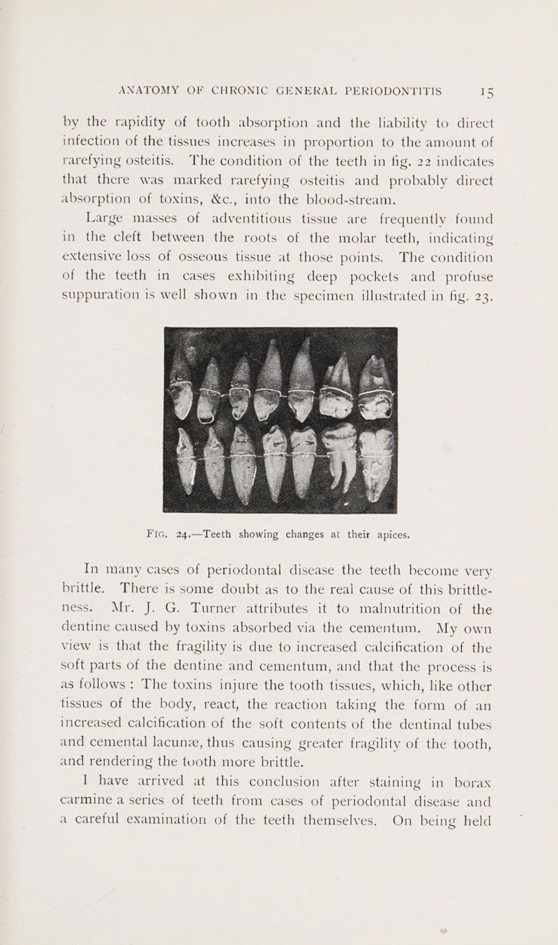 by the rapidity of tooth absorption and the liability to direct infection of the tissues increases in proportion to the amount of rarefying osteitis. The condition of the teeth in fig. 22 indicates that there was marked rarefying osteitis and probably direct absorption of toxins, &amp;c., into the blood-stream. Large masses of adventitious tissue are frequently found in the cleft between the roots of the molar teeth, indicating extensive loss of Osseous tissue at those points. The condition of the teeth in cases exhibiting deep pockets and profuse suppuration is well shown in the specimen illustrated in fig. 23. Fic. 24.—Teeth showing changes at their apices. In many cases of periodontal disease the teeth become very brittle. There is some doubt as to the real cause of this brittle- esc Lip Cmm NUnnenealtripiutesmits tOnmmealnuttition ol tie dentine caused by toxins absorbed via the cementum. My own view is that the fragility is due to increased calcification of the soft parts of the dentine and cementum, and that the process is as follows: The toxins injure the tooth tissues, which, like other tissues of the body, react, the reaction taking the form of an increased calcification of the soft contents of the dentinal tubes and cemental lacunze, thus causing greater fragility of the tooth, and rendering the tooth more brittle. I have arrived at this conclusion after staining in borax carmine a series of teeth from cases of periodontal disease and a careful examination of the teeth themselves. On being held