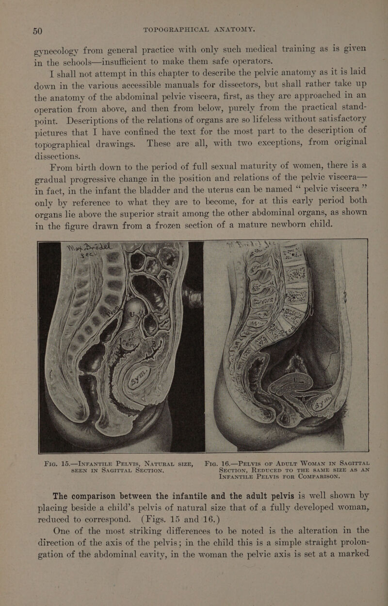 gynecology from general practice with only such medical training as is given in the schools—insufficient to make them safe operators. I shall not attempt in this chapter to describe the pelvic anatomy as it is laid down in the various accessible manuals for dissectors, but shall rather take up the anatomy of the abdominal pelvic viscera, first, as they are approached in an operation from above, and then from below, purely from the practical stand- point. Descriptions of the relations of organs are so lifeless without satisfactory pictures that I have confined the text for the most part to the description of topographical drawings. These are all, with two exceptions, from original dissections. From birth down to the period of full sexual maturity of women, there 1s a eradual progressive change in the position and relations of the pelvic viscera— in fact, in the infant the bladder and the uterus can be named “ pelvic viscera ”” only by reference to what they are to become, for at this early period both organs lie above the superior strait among the other abdominal organs, as shown in the figure drawn from a frozen section of a mature newborn child. Fic. 15.—INFANTILE Pretvis, NaTurau sizB, Fic. 16.—PELtyvis or ApuLT WoMAN IN SAGITTAL SEEN IN SAGITTAL SECTION. SECTION, REDUCED TO THE SAME SIZE AS AN INFANTILE PELVIS FOR COMPARISON. The comparison between the infantile and the adult pelvis is well shown by placing beside a child’s pelvis of natural size that of a fully developed woman, reduced to correspond. (Figs. 15 and 16.) One of the most striking differences to be noted is the alteration in the direction of the axis of the pelvis; in the child this is a simple straight prolon- gation of the abdominal cavity, in the woman the pelvic axis is set at a marked