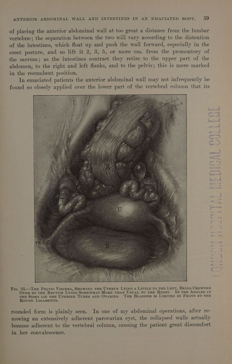 of placing the anterior abdominal wall at too great a distance from the lumbar vertebree; the separation between the two will vary according to the distention of the intestines, which float up and push the wall Reed especially in the erect posture, a so lift it 2, 3, 5, or more cm. from the promontory of the sacrum; as the intestines contract they retire to the upper part of the abdomen, to the right and left flanks, and to the pelvis; this is more marked in the recumbent position. In emaciated patients the anterior abdominal wall may not infrequently be found go closely applied over the lower part of the vertebral column that its Fic. 25.—Tue Pretvic Viscera, SHOWING THE UTERUS LyING A LITTLE TO THE Lert, BEING CROWDED OVER BY THE RECTUM LYING SoMEWHAT MoRE THAN USUAL TO THE RIGHT. IN THE ANGLES AT THE SIDES LIE THE UTERINE TUBES AND OVARIES. THE BLADDER IS LIMITED IN FRONT BY THE Rounp LIGAMENTS. rounded form is plainly seen. In one of my abdominal operations, after re- moving an extensively adherent parovarian cyst, the collapsed walls actually became adherent to the vertebral column, causing the patient great discomfort in her convalescence.