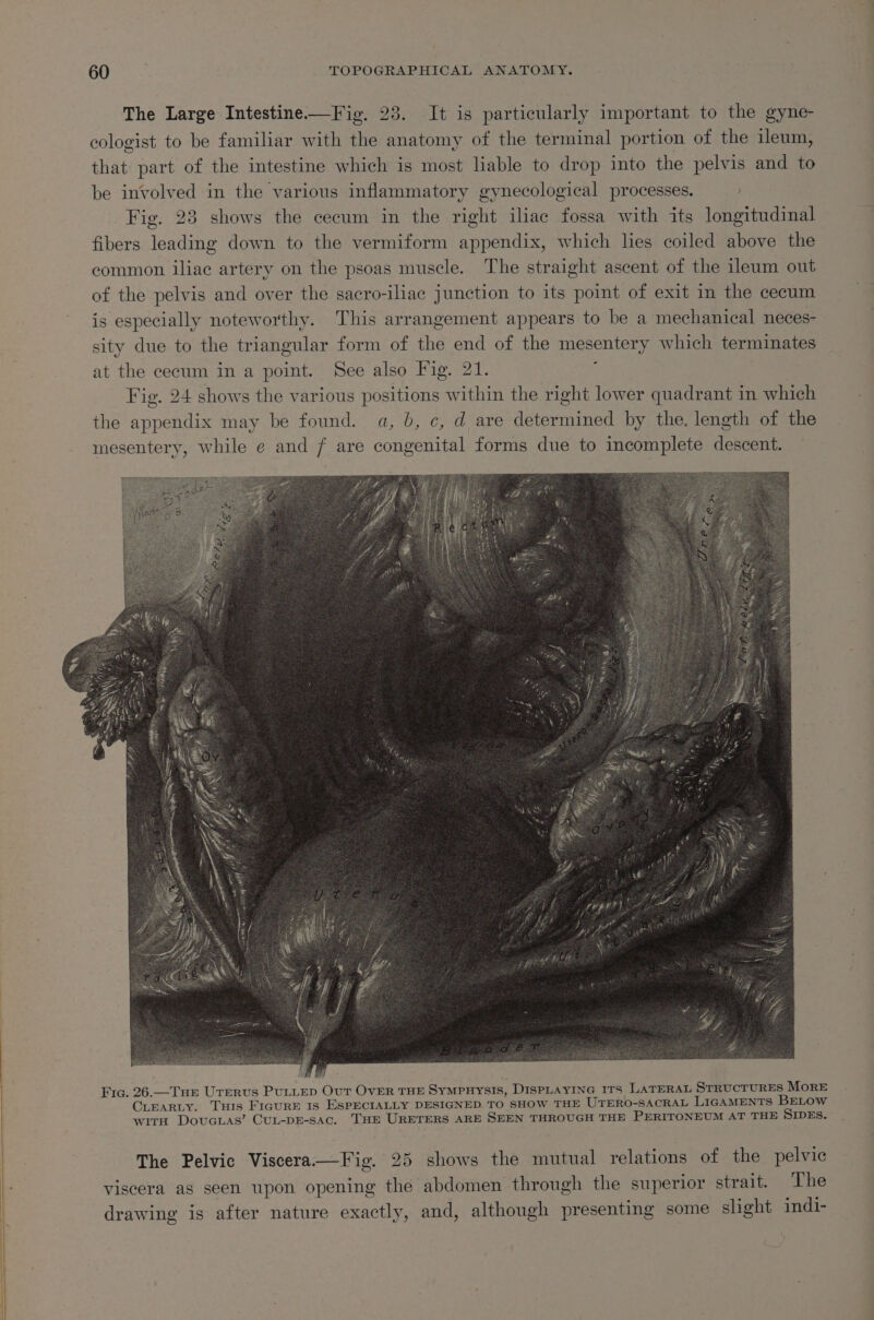 The Large Intestine—Fig. 23. It is particularly important to the gyne- ecologist to be familiar with the anatomy of the terminal portion of the ileum, that part of the intestine which is most lable to drop into the pelvis and to be involved in the various inflammatory gynecological processes. ) Fig. 283 shows the cecum in the right iliac fossa with its longitudinal fibers leading down to the vermiform appendix, which lies coiled above the common iliac artery on the psoas muscle. The straight ascent of the ileum out of the pelvis and over the sacro-iliac junction to its point of exit in the cecum is especially noteworthy. This arrangement appears to be a mechanical neces- sity due to the triangular form of the end of the mesentery which terminates at the cecum in a point. See also Fig. 21. : Fig. 24 shows the various positions within the right lower quadrant in which the appendix may be found. a, b, c, d are determined by the. length of the mesentery, while e and 7 are congenital forms due to incomplete descent. Fic. 26.—Tue Urervus Puttep Our Ovir THE SympnHysis, DISPLAYING ITS LATERAL STRUCTURES More CLEARLY. THis FIGURE IS ESPECIALLY DESIGNED. TO SHOW THE UTERO-SACRAL LIGAMENTS BELOW witH Dovuauas’ CuL-pE-sac. THE URETERS ARE SEEN THROUGH THE PERITONEUM AT THE SIDES. The Pelvic Viscera—Fig. 25 shows the mutual relations of the pelvic viscera as seen upon opening the abdomen through the superior strait. The drawing is after nature exactly, and, although presenting some slight indi-